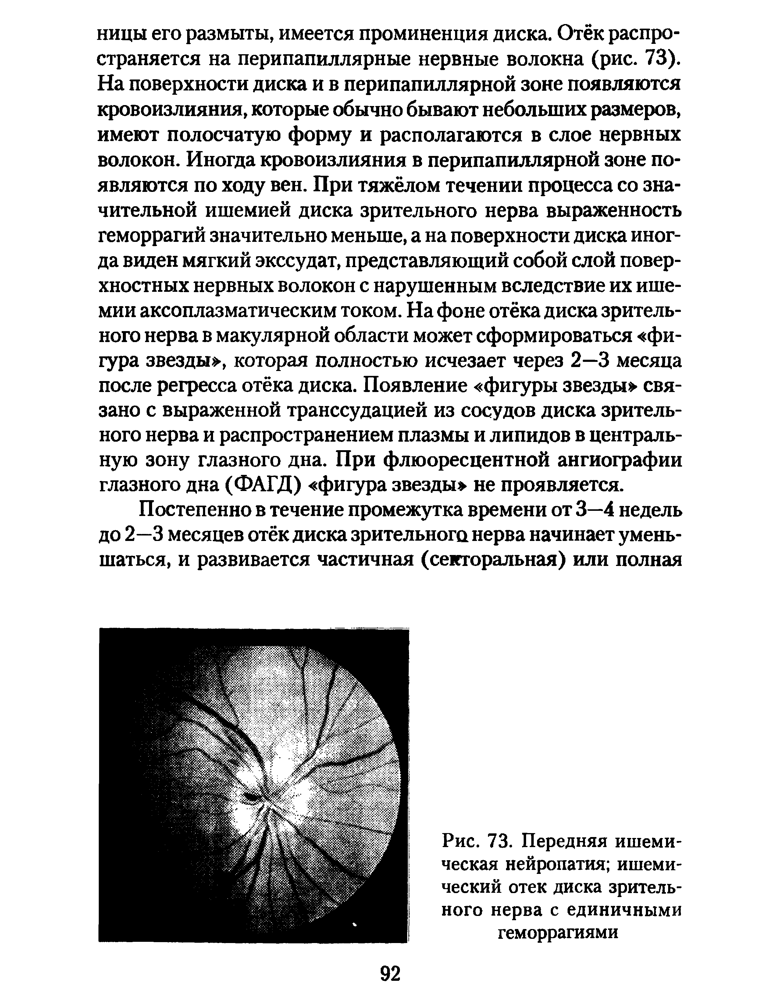 Рис. 73. Передняя ишемическая нейропатия ишемический отек диска зрительного нерва с единичными геморрагиями...