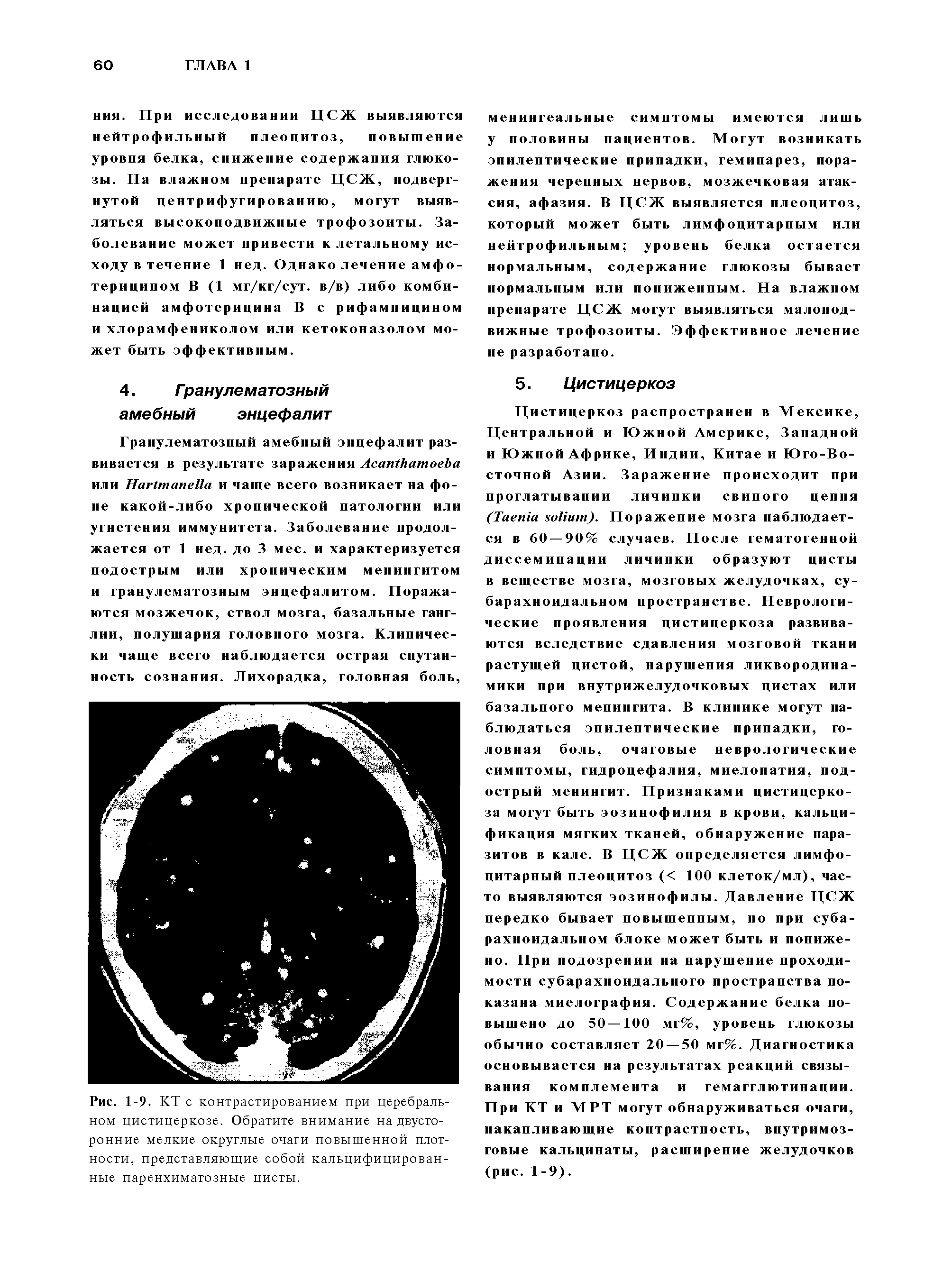 Рис. 1-9. КТ с контрастированием при церебральном цистицеркозе. Обратите внимание на двусторонние мелкие округлые очаги повышенной плотности, представляющие собой кальцифицированные паренхиматозные цисты.