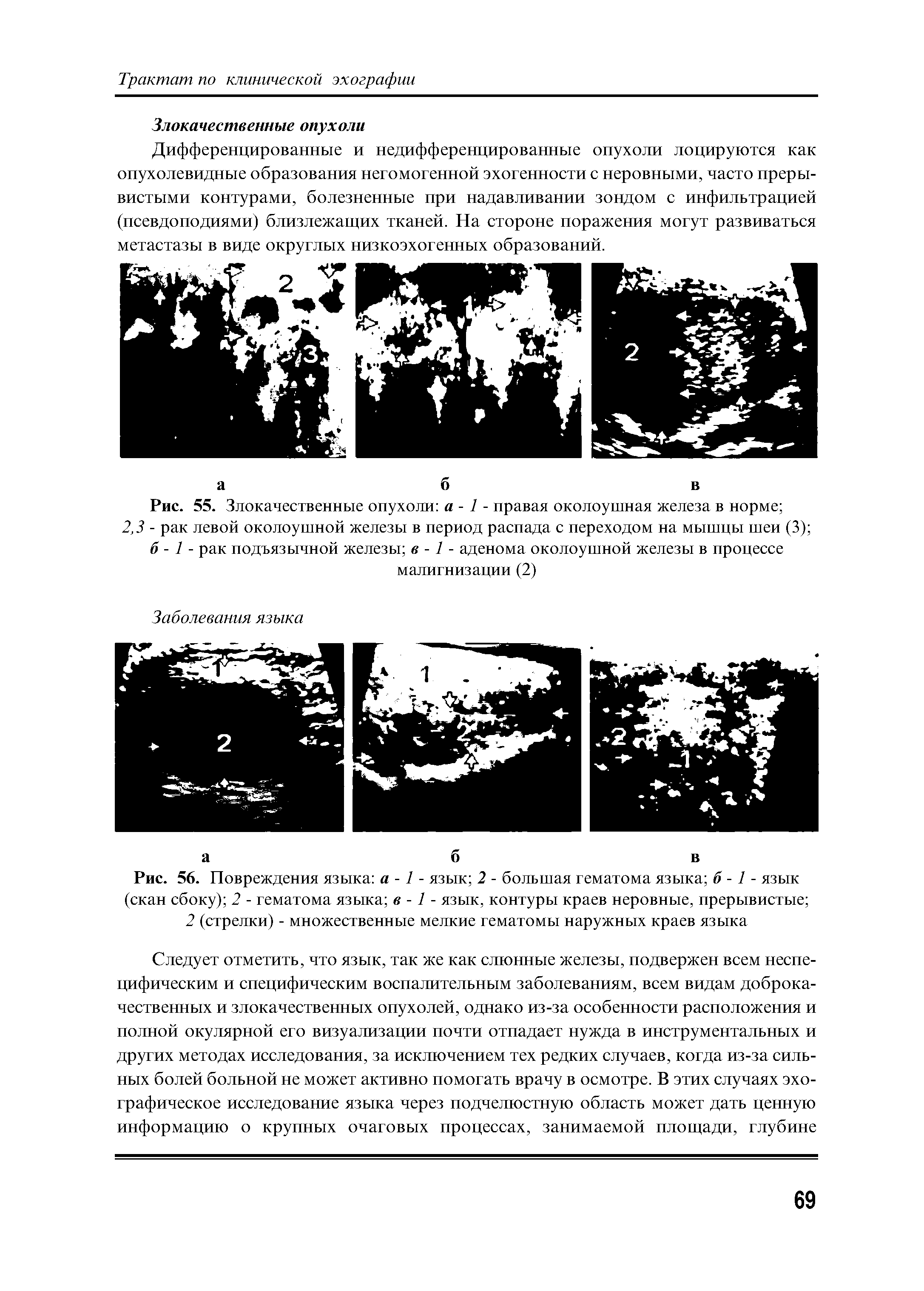 Рис. 56. Повреждения языка а -1 - язык 2 - большая гематома языка б -1 - язык (скан сбоку) 2 - гематома языка в -1 - язык, контуры краев неровные, прерывистые ...