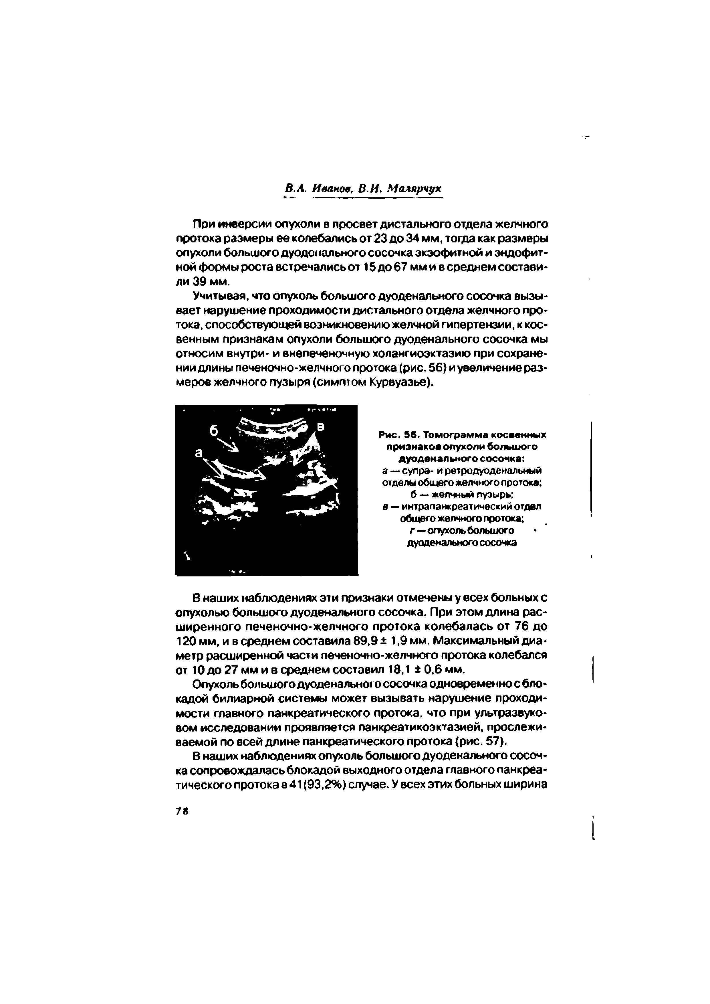 Рис. 56. Томограмма косвенных признаков опухоли большого дуоденального сосочка а — супра- и ретродуоденальный отделы общего желчного протока б — желчный пузырь ...