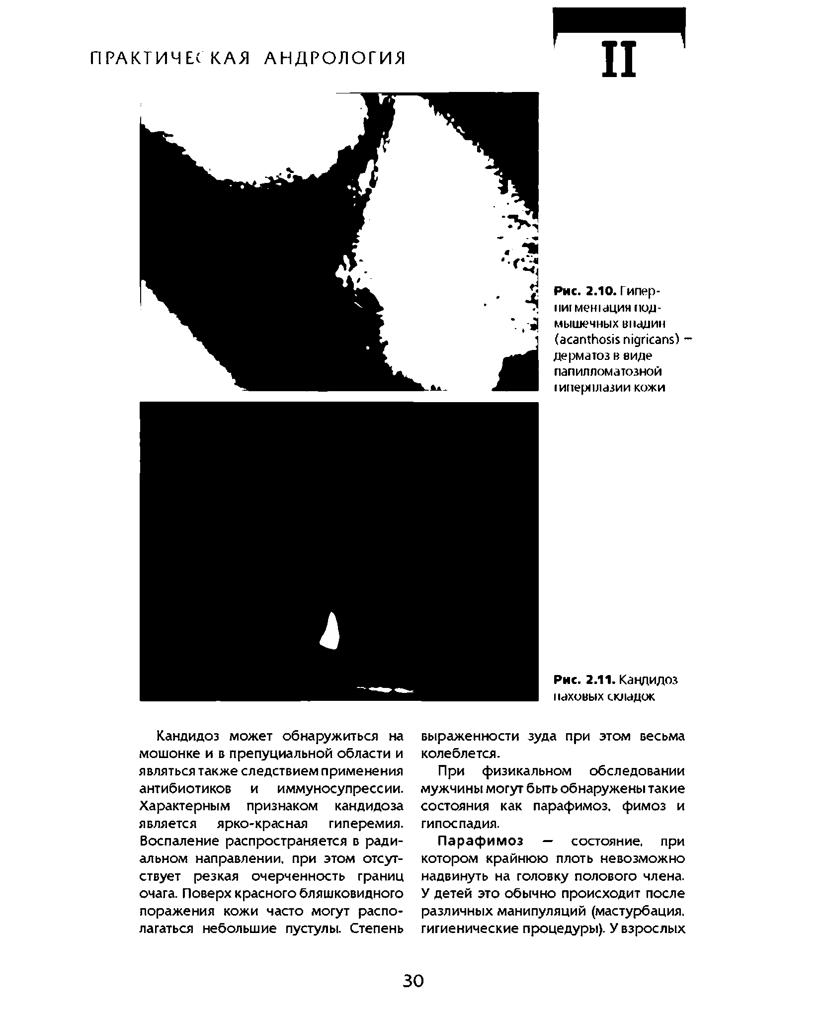 Рис. 2.10. Гипер-пи[ мен1 цин подмышечных впадин ( ) -дерматоз в виде папилломатозной гиперплазии кожи...