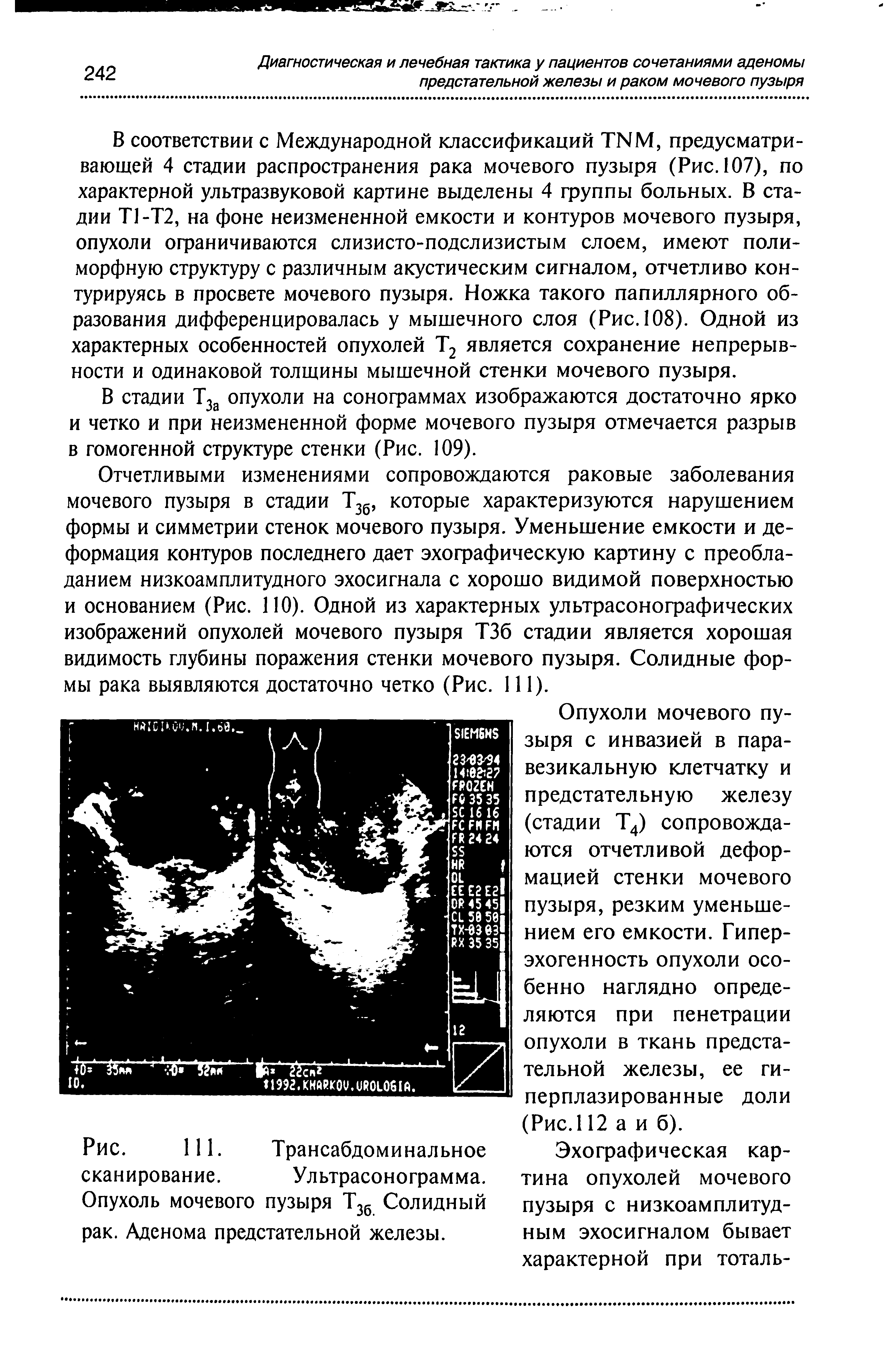 Рис. 111. Трансабдоминальное сканирование. Ультрасонограмма. Опухоль мочевого пузыря Т3б Солидный рак. Аденома предстательной железы.