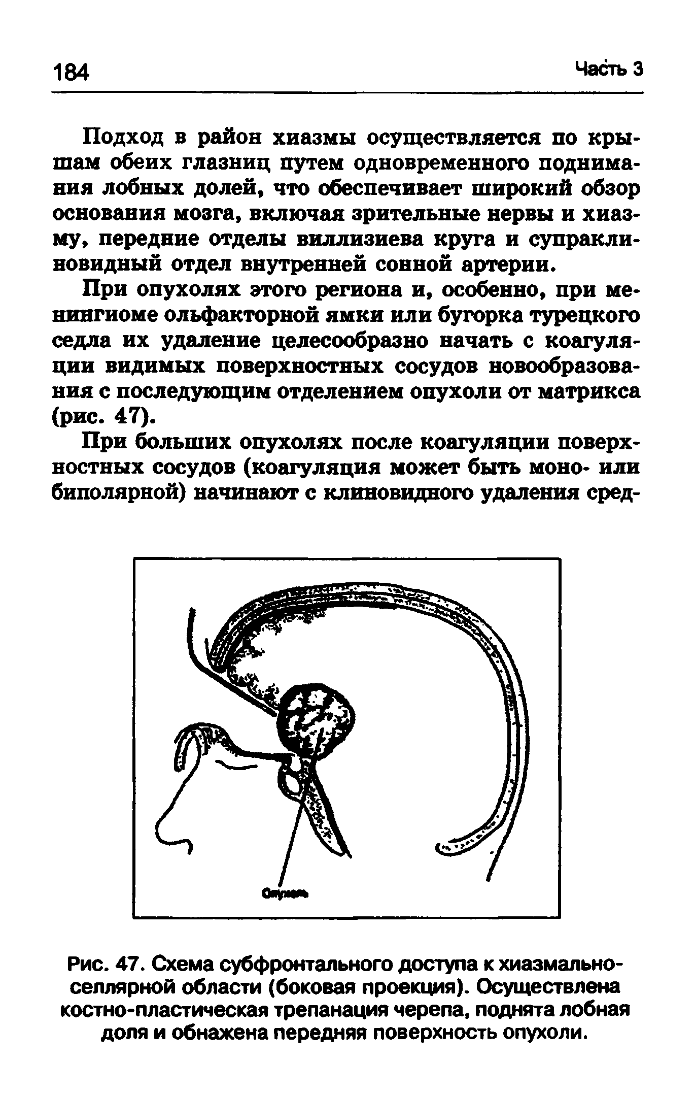 Рис. 47. Схема субфронтального доступа к хиазмальноселлярной области (боковая проекция). Осуществлена костно-пластическая трепанация черепа, поднята лобная доля и обнажена передняя поверхность опухоли.