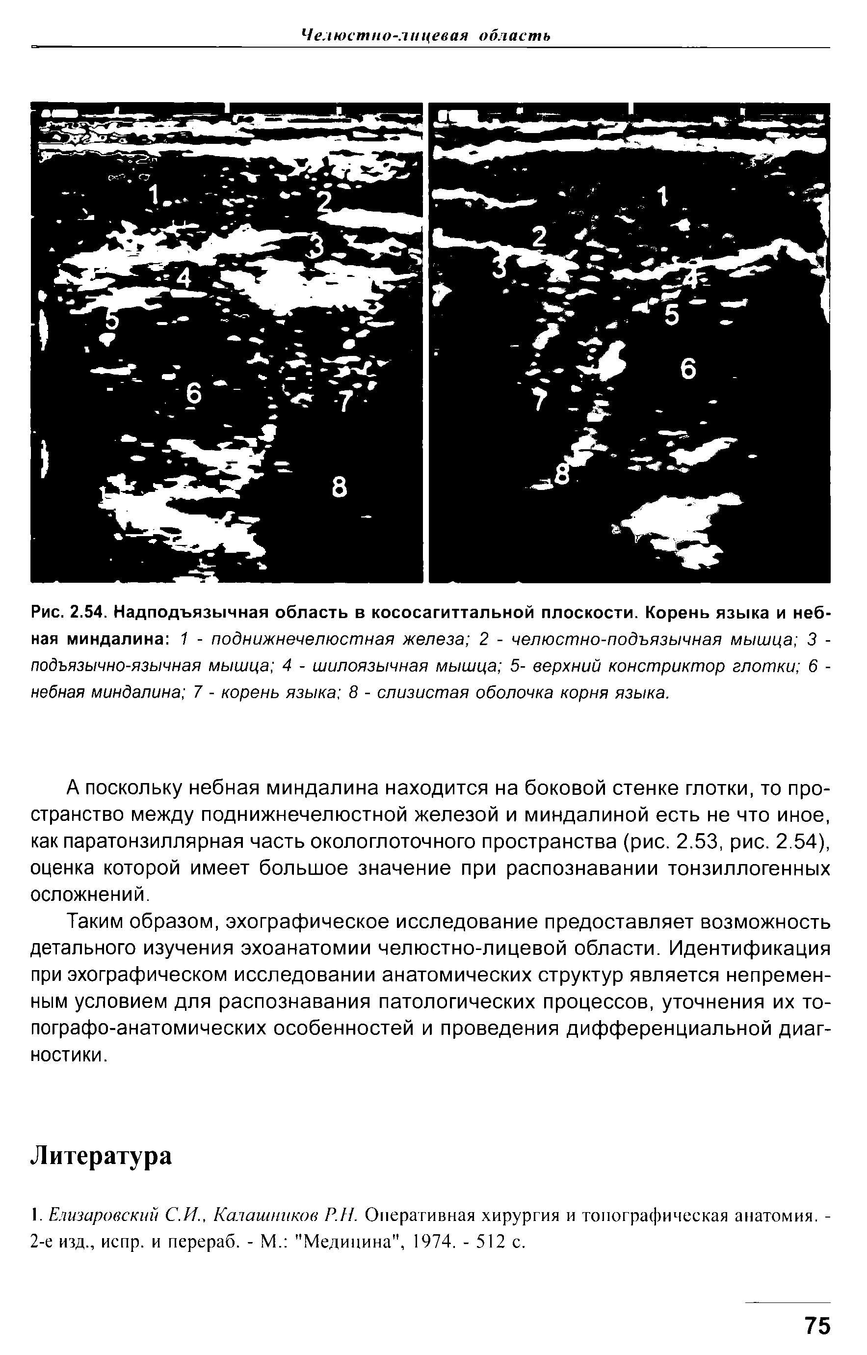 Рис. 2.54. Надподъязычная область в кососагиттальной плоскости. Корень языка и небная миндалина 1 - поднижнечелюстная железа 2 - челюстно-подъязычная мышца 3 -подъязычно-язычная мышца 4 - шилоязычная мышца 5- верхний констриктор глотки 6 -небная миндалина 7 - корень языка 8 - слизистая оболочка корня языка.