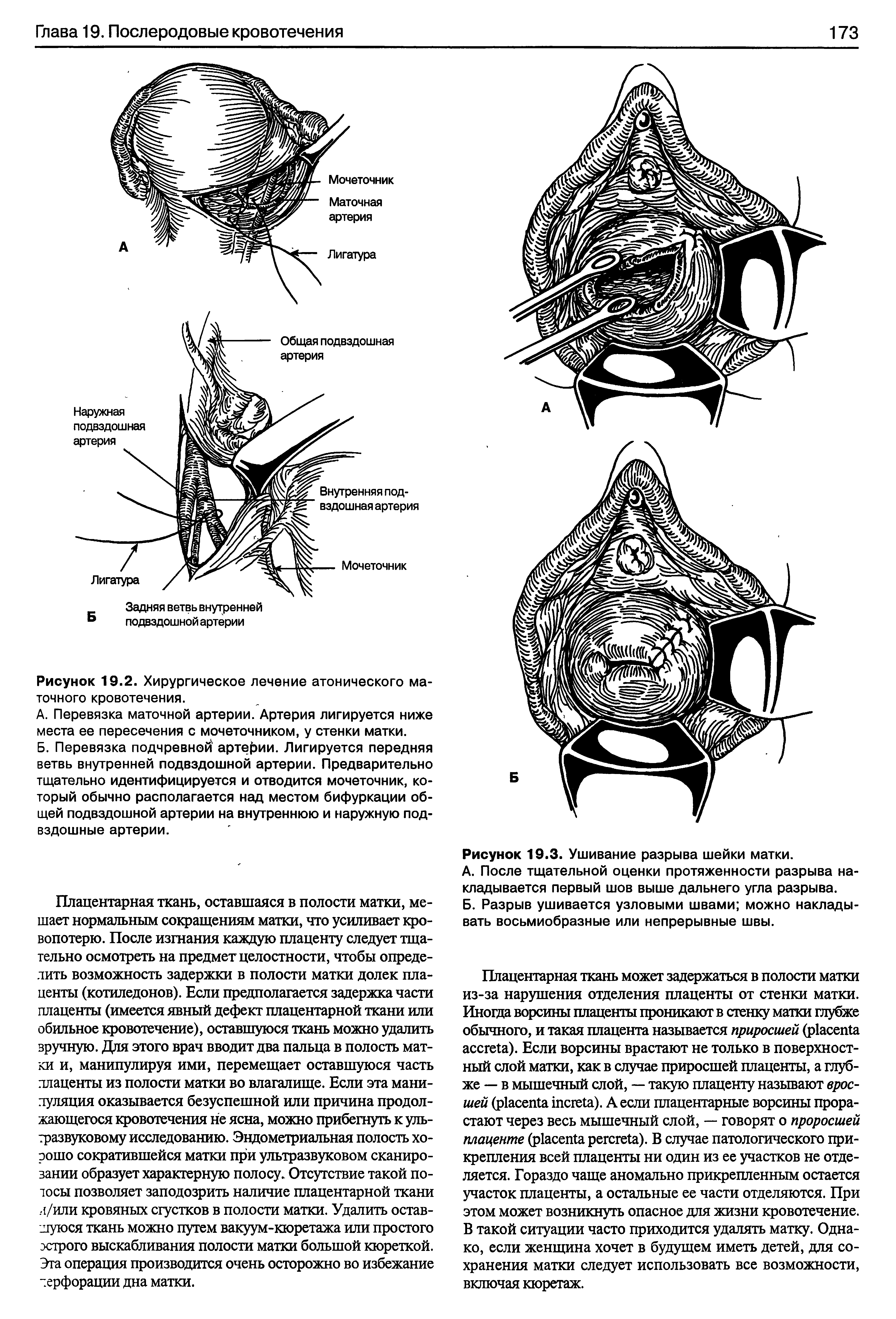 Рисунок 19.2. Хирургическое лечение атонического маточного кровотечения.