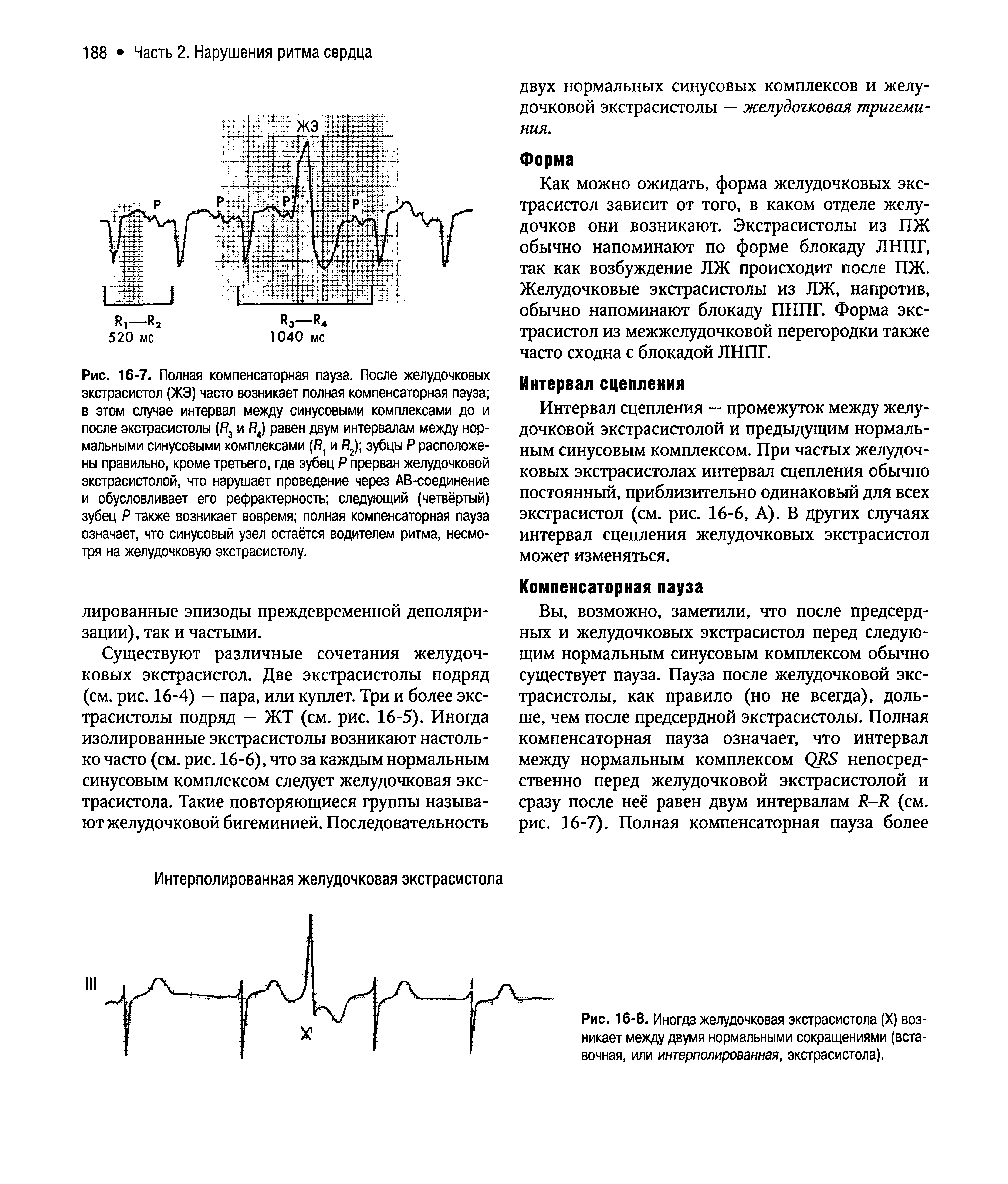 Рис. 16-8. Иногда желудочковая экстрасистола (X) возникает между двумя нормальными сокращениями (вставочная, или интерполированная, экстрасистола).