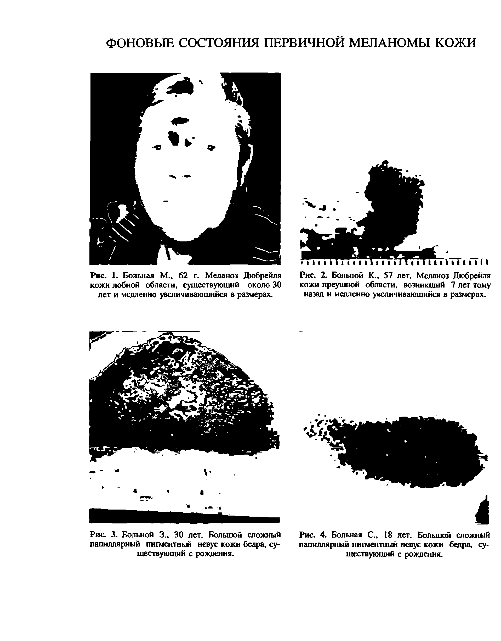 Рис. 3. Больной 3., 30 лет. Большой сложный папиллярный пигментный невус кожи бедра, существующий с рождения.