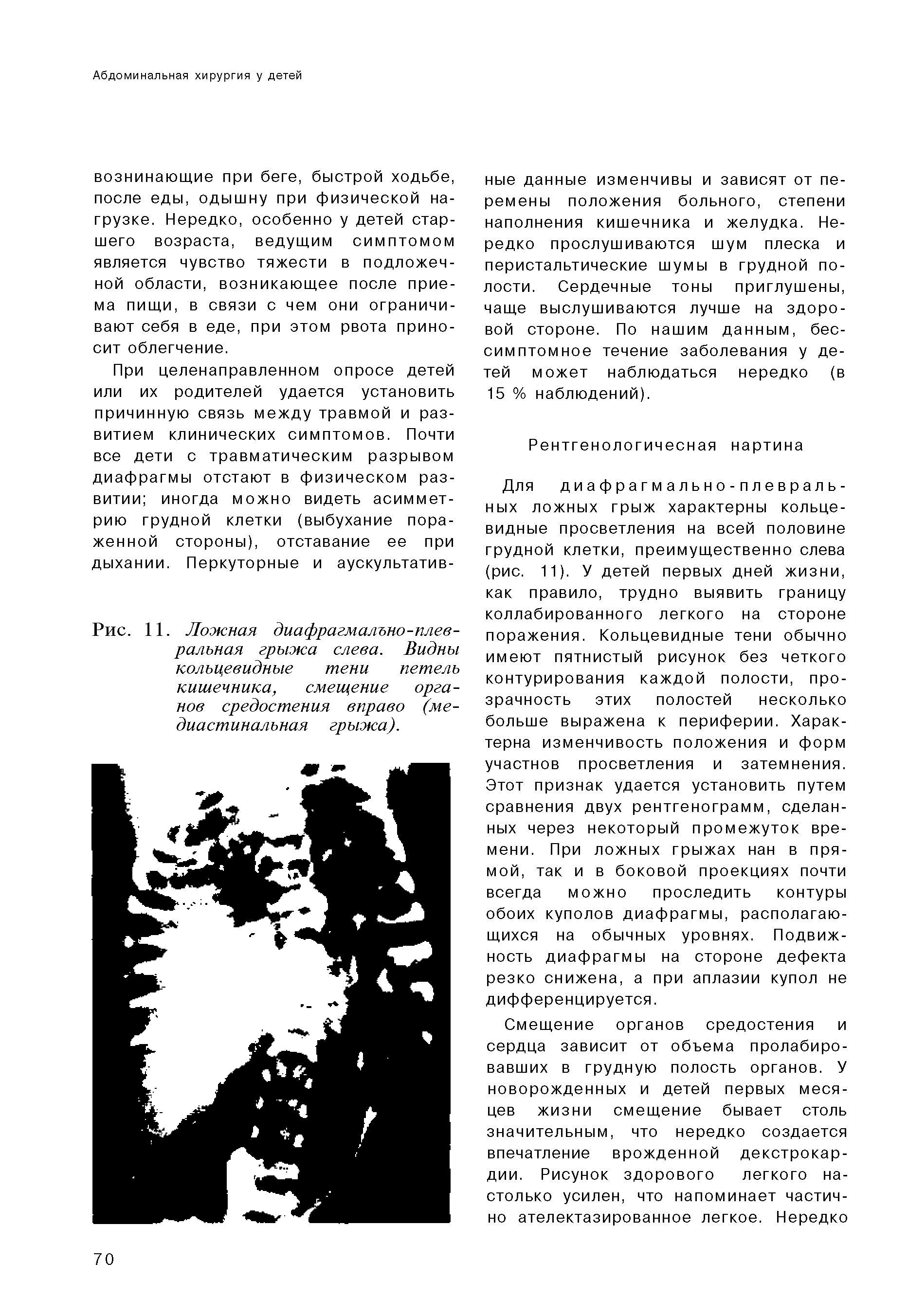 Рис. 11. Ложная диафрагмально-плевральная грыжа слева. Видны кольцевидные тени петель кишечника, смещение органов средостения вправо (медиастинальная грыжа).