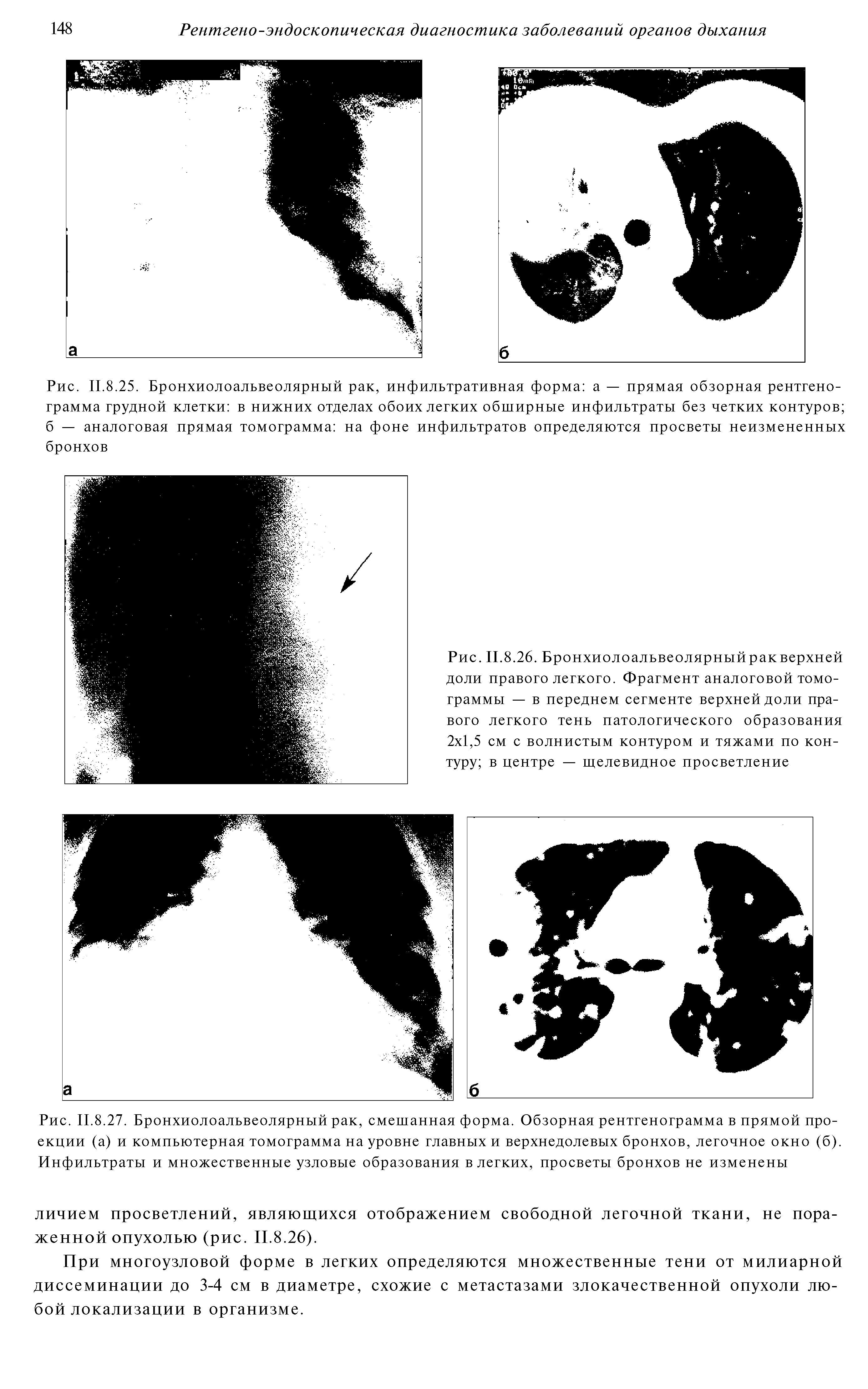 Рис. II.8.25. Бронхиолоальвеолярный рак, инфильтративная форма а — прямая обзорная рентгенограмма грудной клетки в нижних отделах обоих легких обширные инфильтраты без четких контуров б — аналоговая прямая томограмма на фоне инфильтратов определяются просветы неизмененных бронхов...