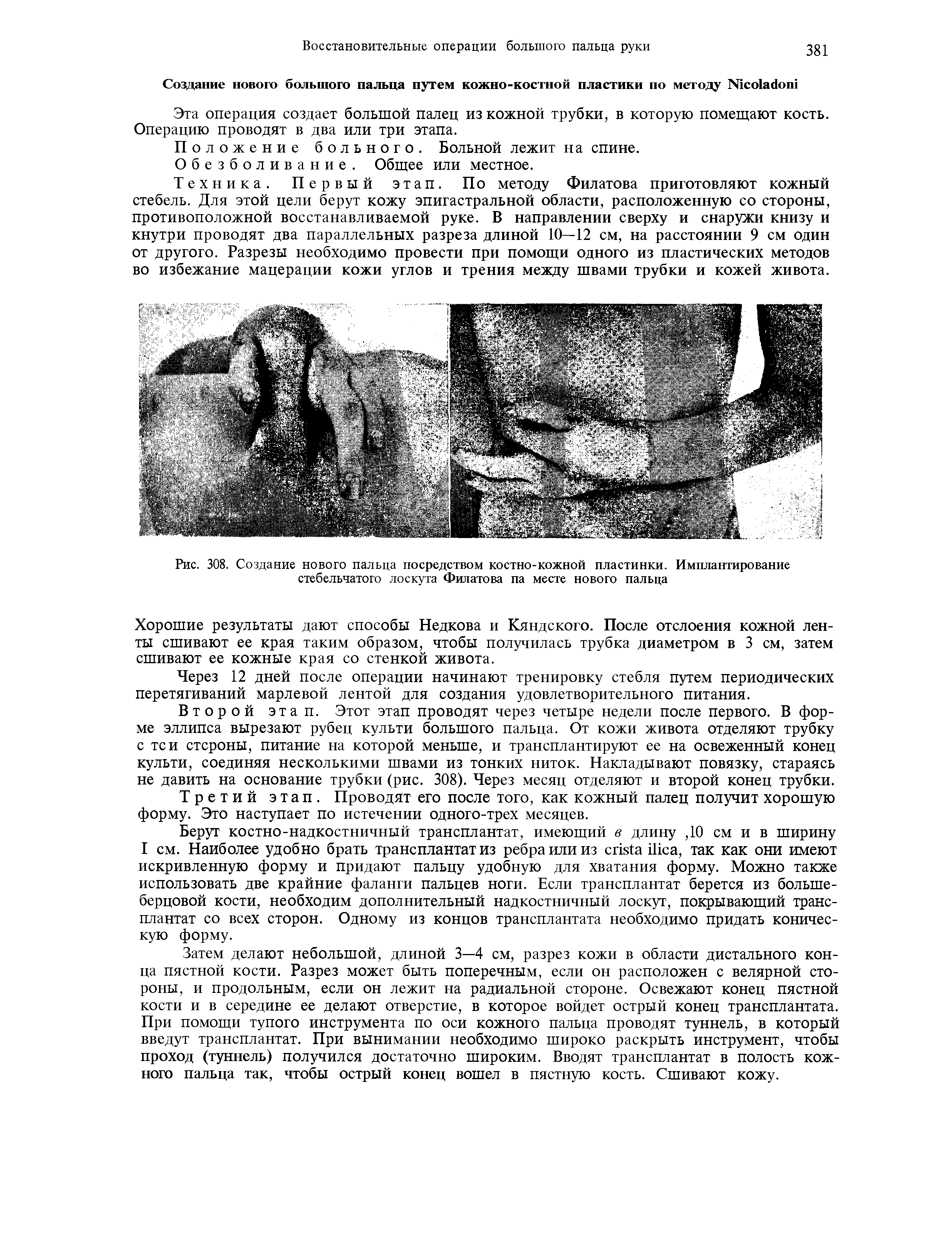 Рис. 308. Создание нового пальца посредством костно-кожной пластинки. Имплантирование стебельчатого лоскута Филатова па месте нового пальца...