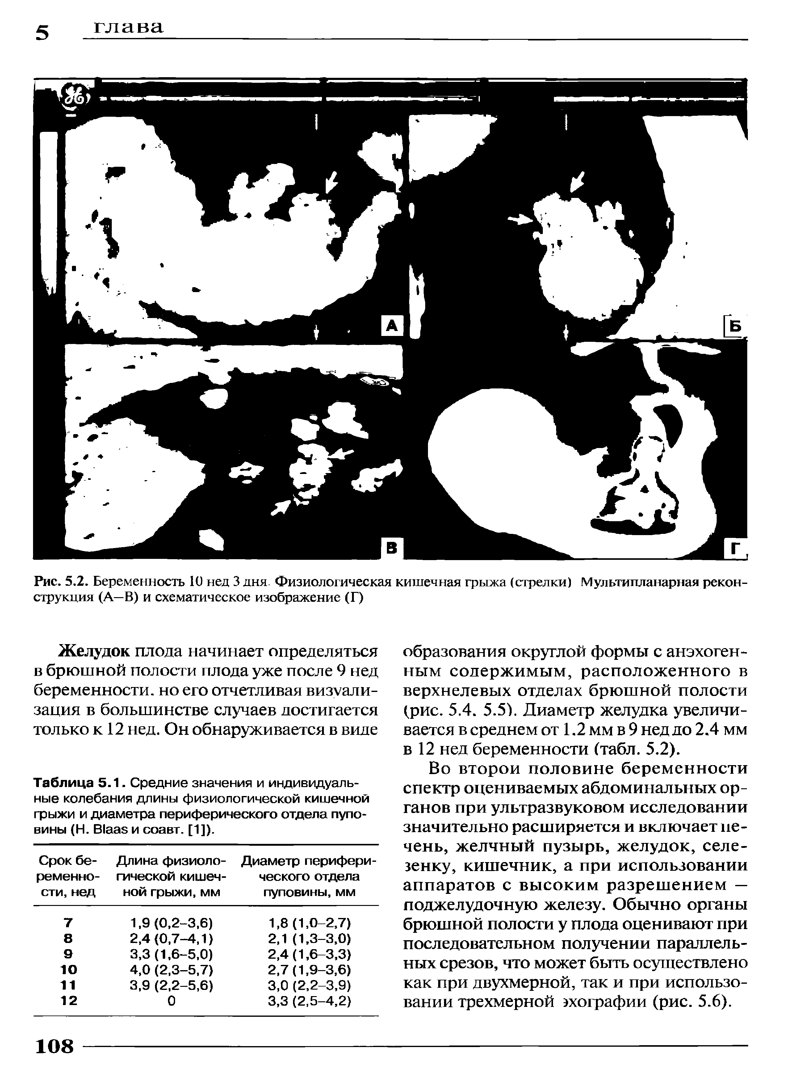 Рис. 5.2. Беременность 10 нед 3 дня Физиологическая кишечная грыжа (стрелки) Мультипланарная реконструкция (А—В) и схематическое изображение (Г)...