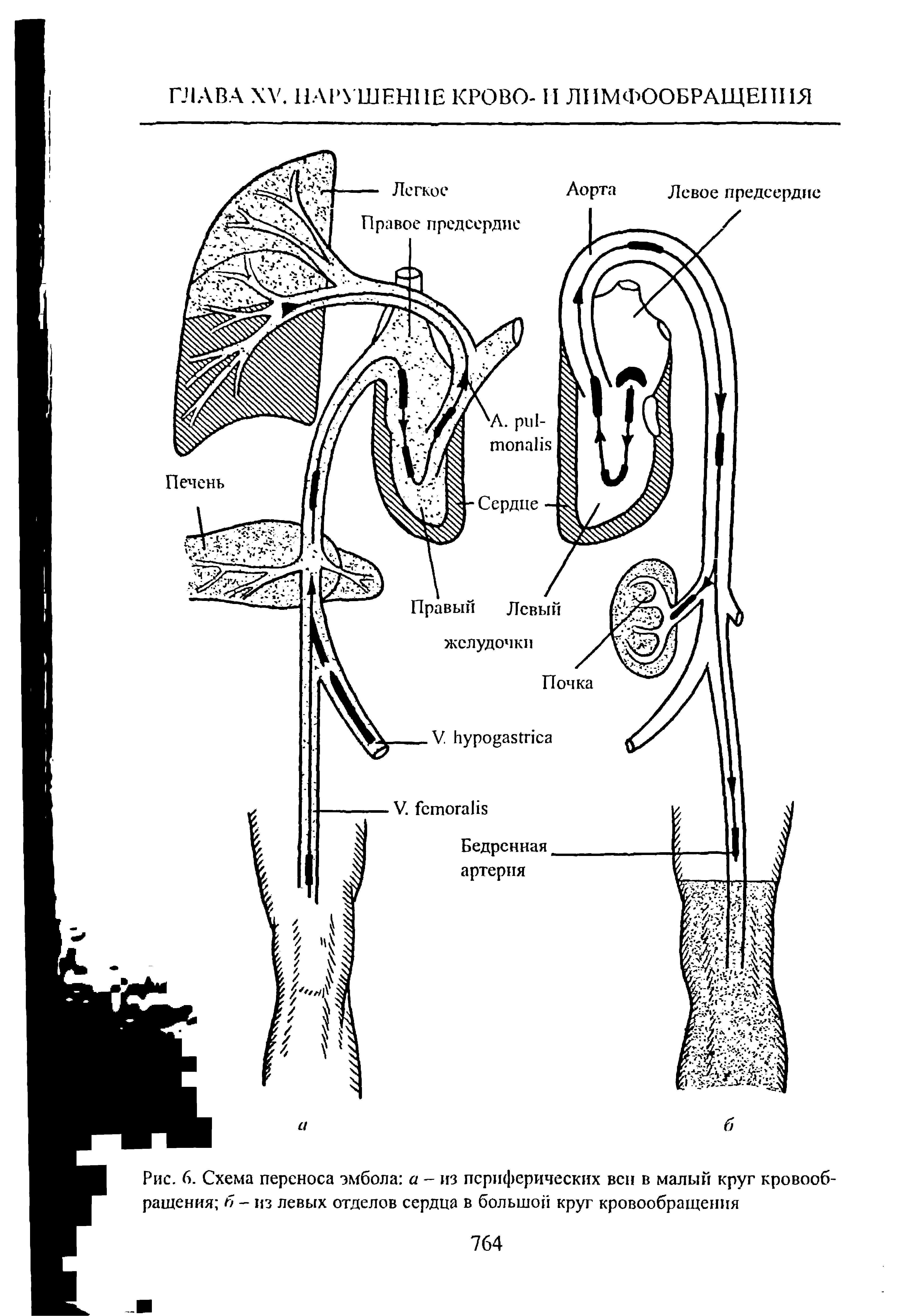 Рис. 6. Схема переноса эмбола а - из периферических вен в малый круг кровообращения б - из левых отделов сердца в большой круг кровообращения...