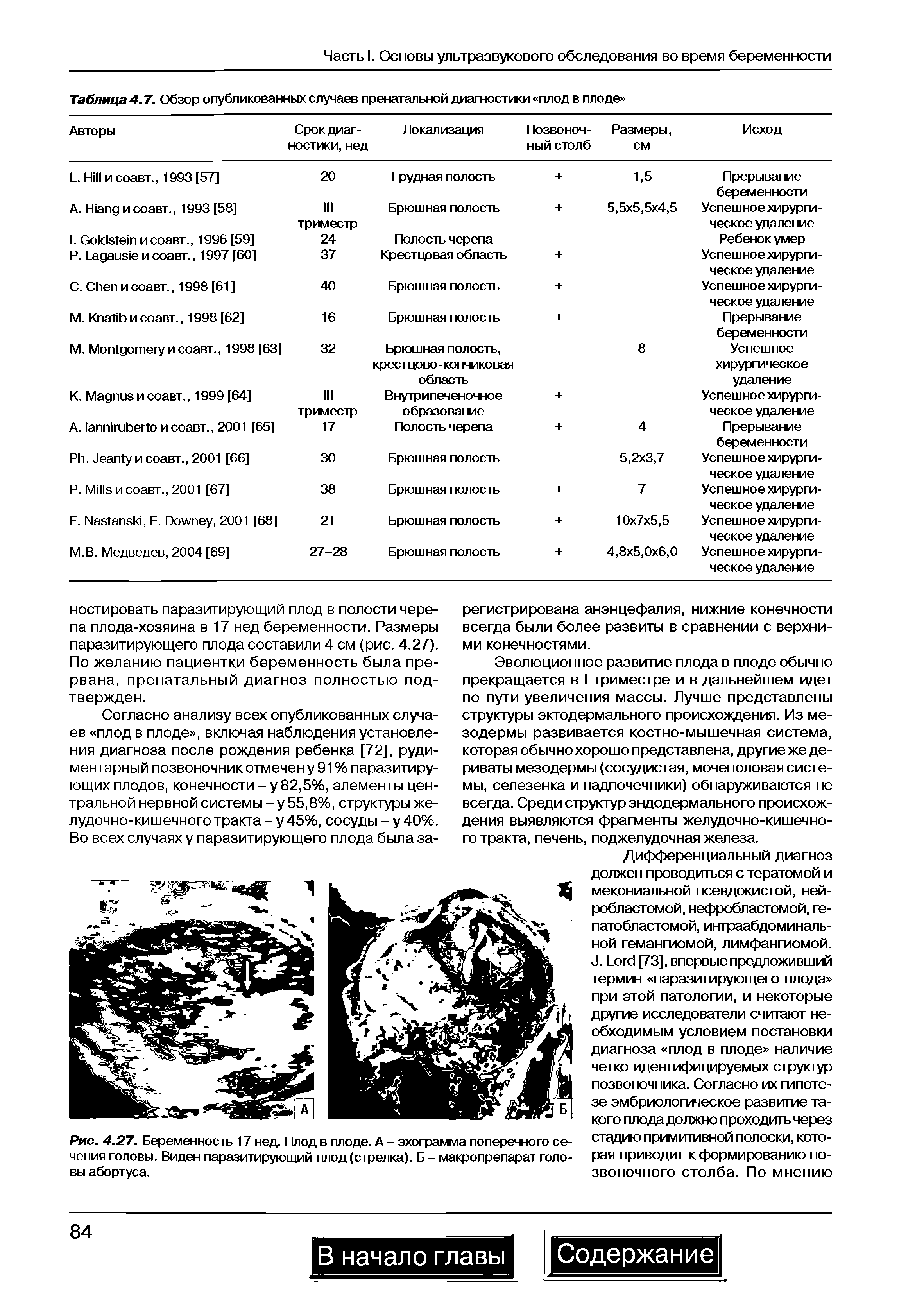 Рис. 4.27. Беременность 17 нед. Плод в плоде. А - эхограмма поперечного сечения головы. Виден паразитирующий плод (стрелка). Б - макропрепарат головы абортуса.