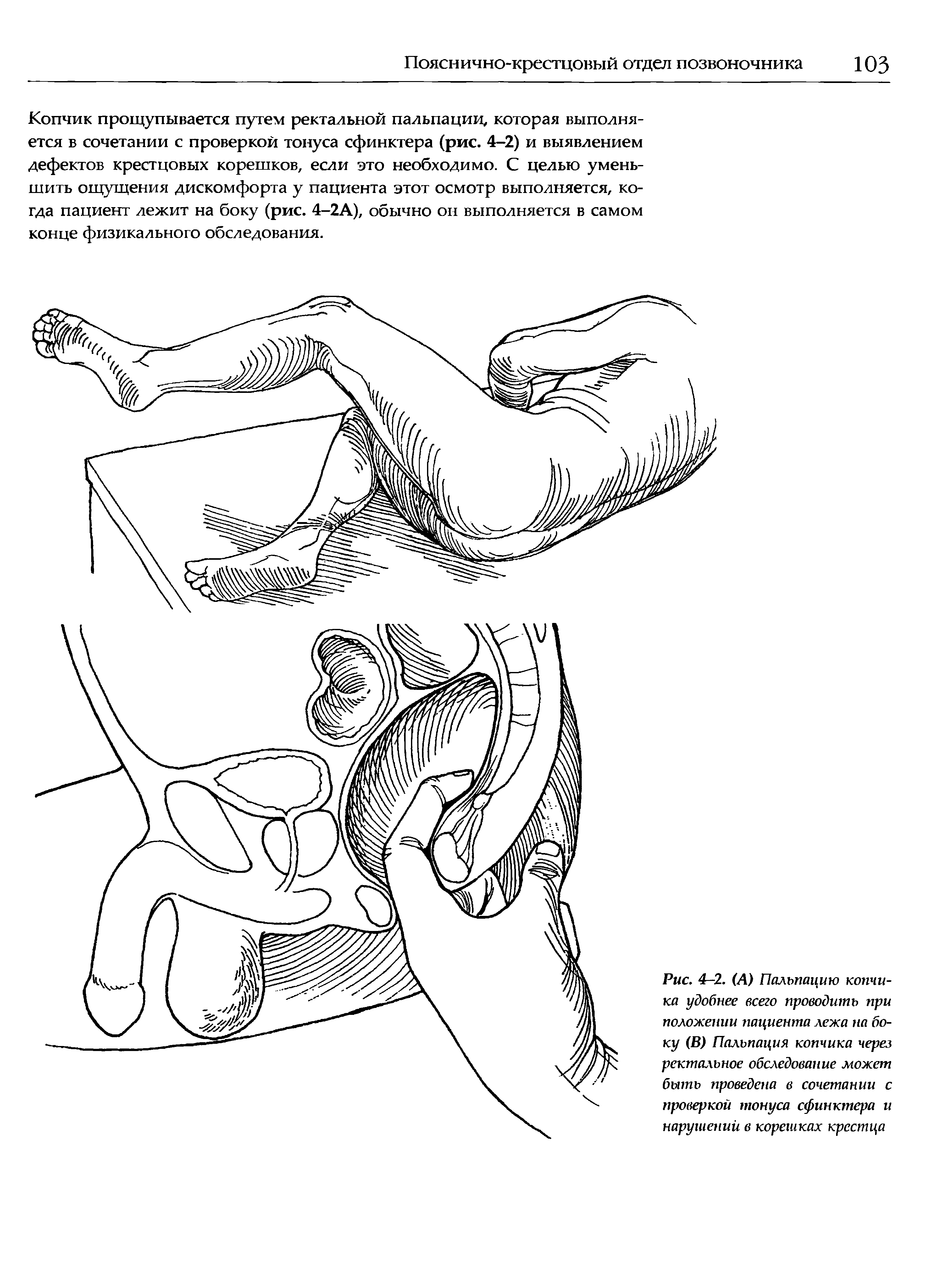 Рис. 4-2. (А) Пальпацию копчика удобнее всего проводить при положении пациента лежа на боку (В) Пальпация копчика через ректальное обследование может быть проведена в сочетании с проверкой тонуса сфинктера и нарушений в корешках крестца...