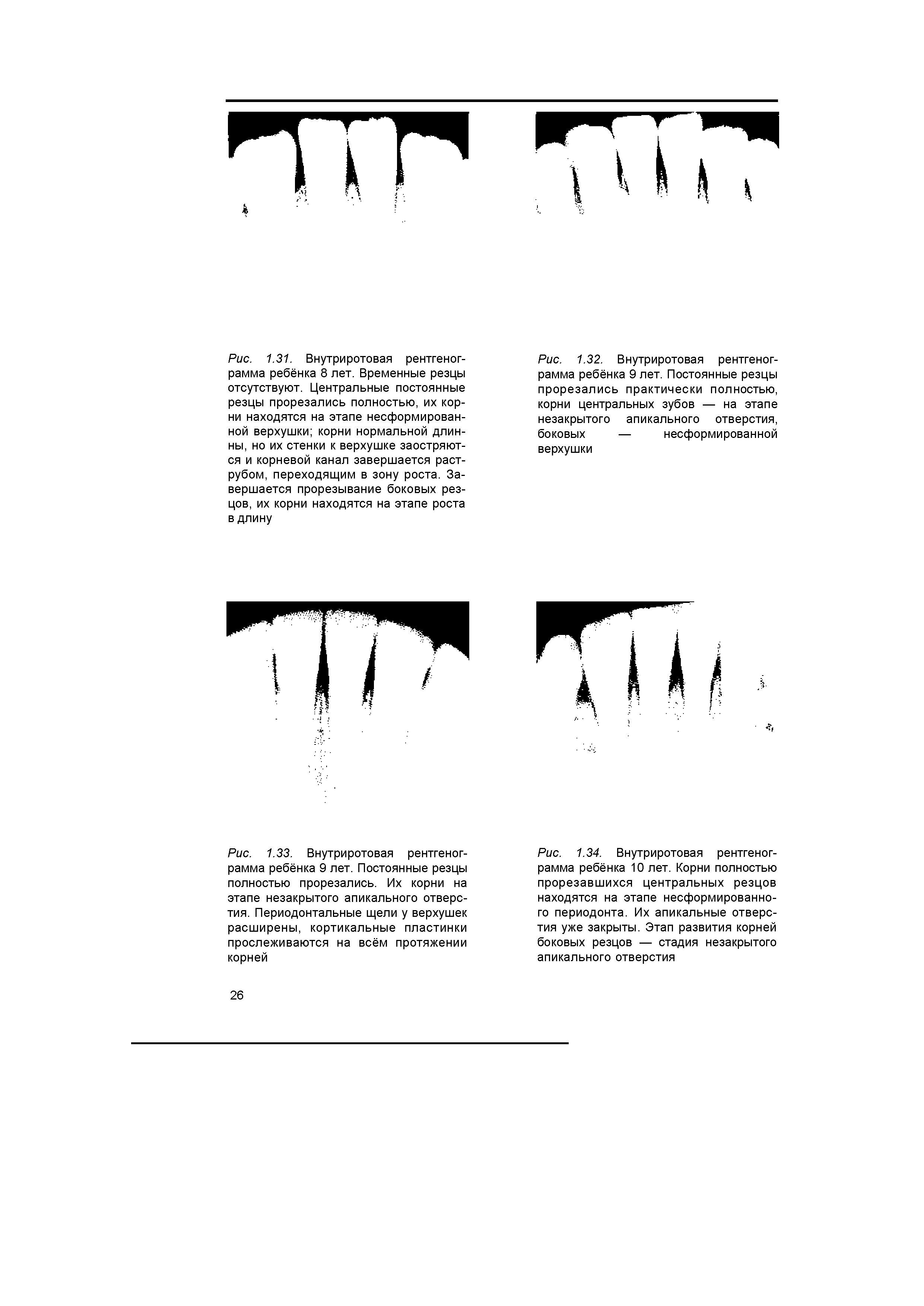 Рис. 1.34. Внутриротовая рентгенограмма ребёнка 10 лет. Корни полностью прорезавшихся центральных резцов находятся на этапе несформированно-го периодонта. Их апикальные отверстия уже закрыты. Этап развития корней боковых резцов — стадия незакрытого апикального отверстия...