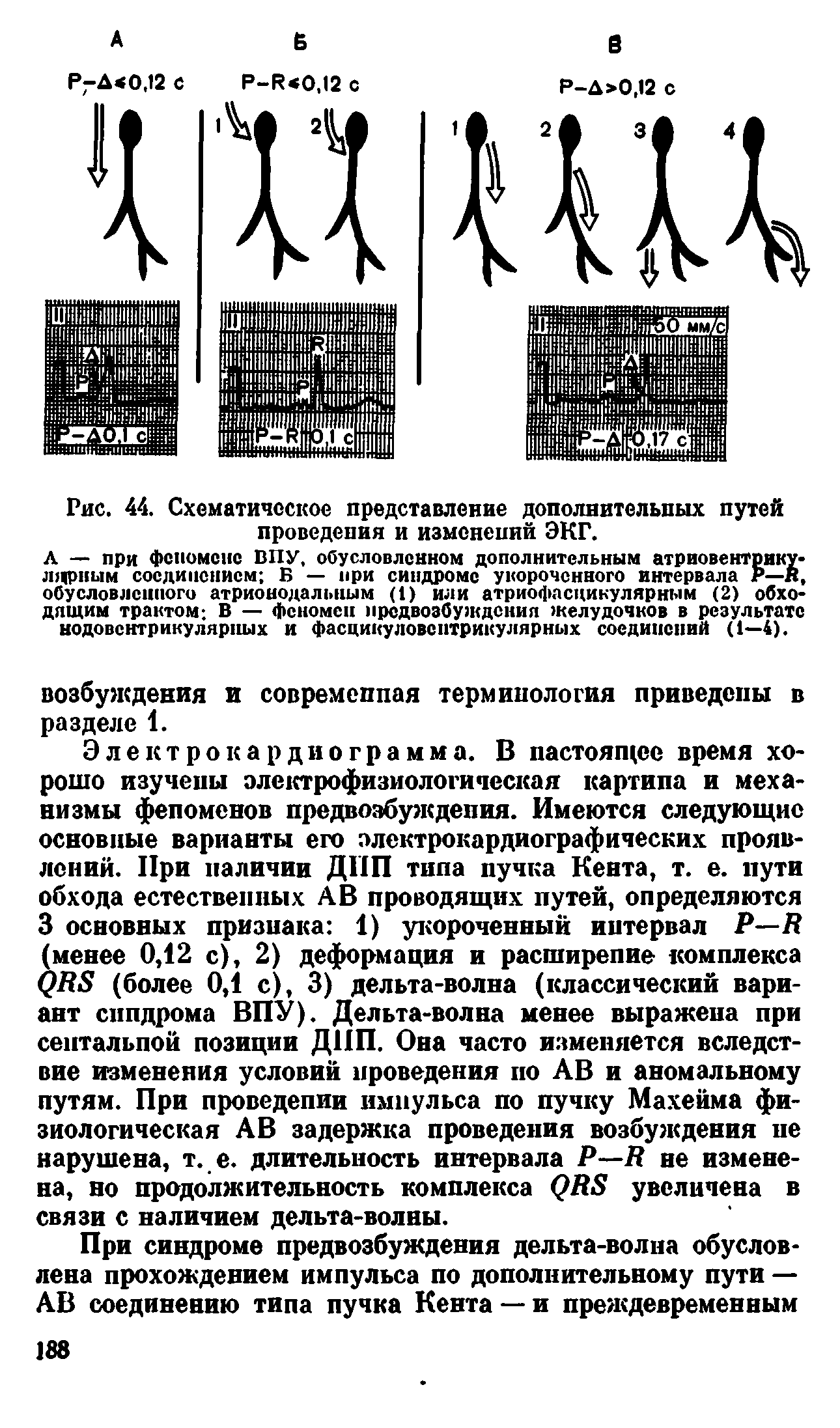 Рис. 44. Схематическое представление дополнительных путей проведения и изменений ЭКГ.