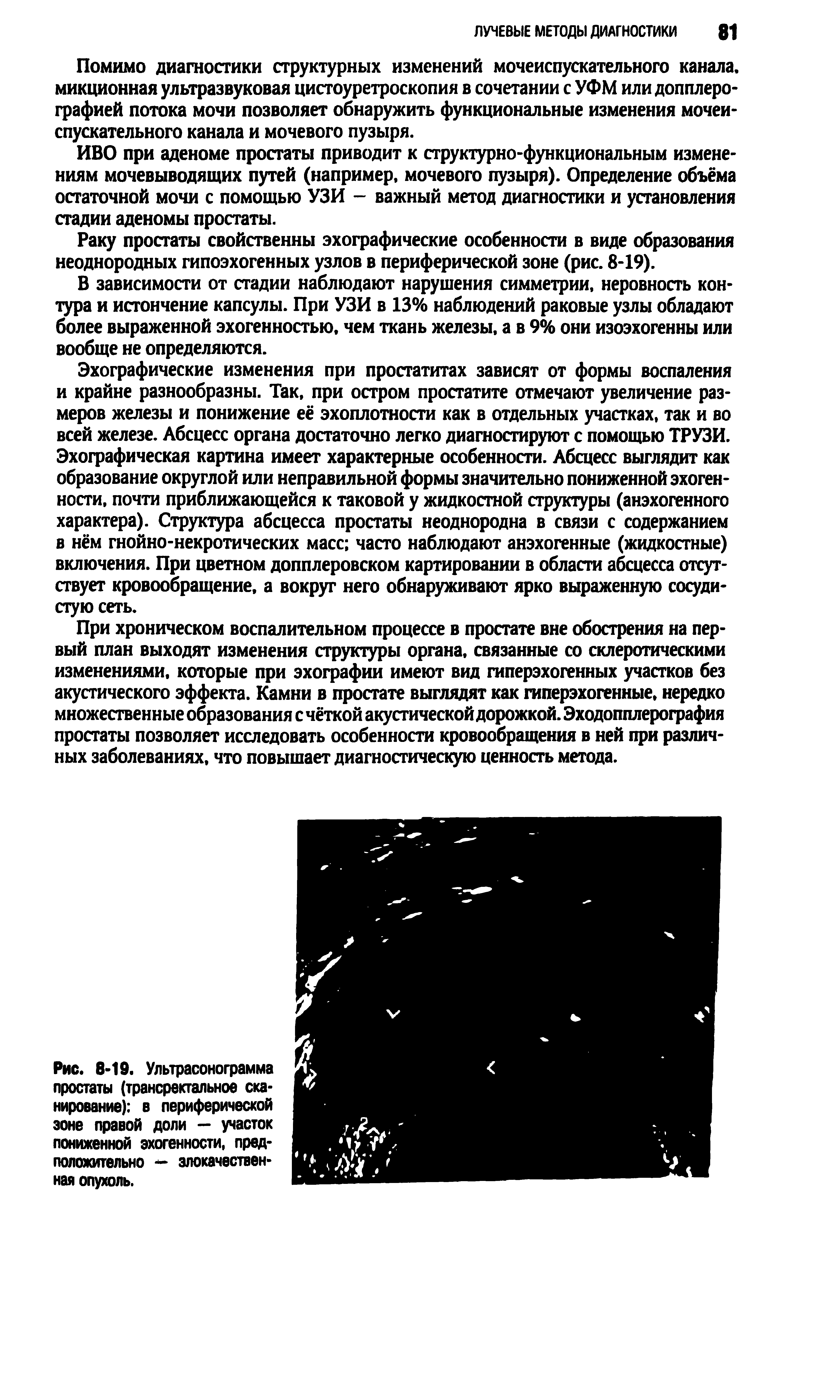 Рис. 8-19. Ультрасонограмма простаты (трансректальное сканирование) в периферической эоне правой доли — участок пониженной эхогенности, предположительно — злокачественная опухоль.