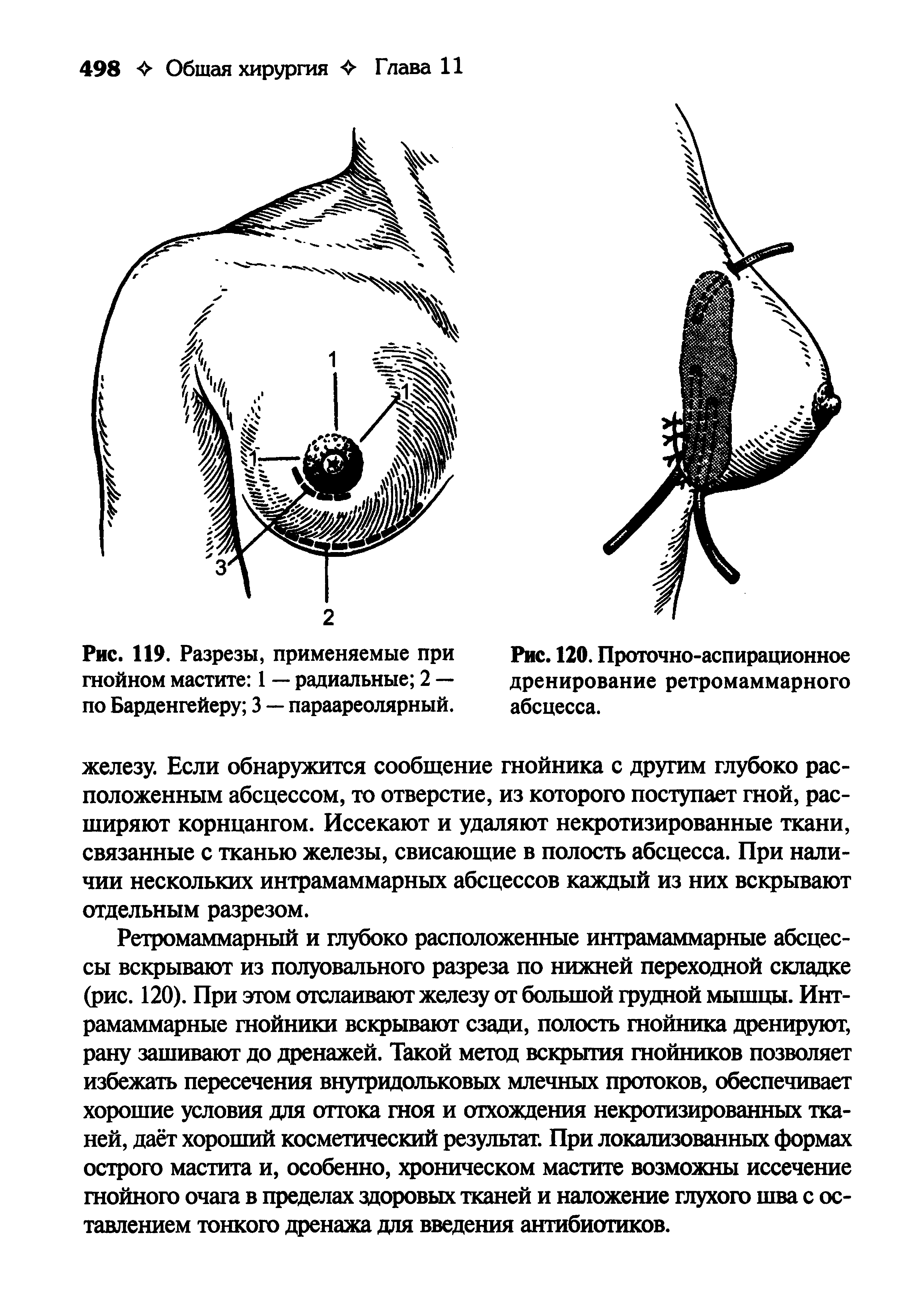 Рис. 119. Разрезы, применяемые при гнойном мастите 1 — радиальные 2 — по Барденгейеру 3 — параареолярный.