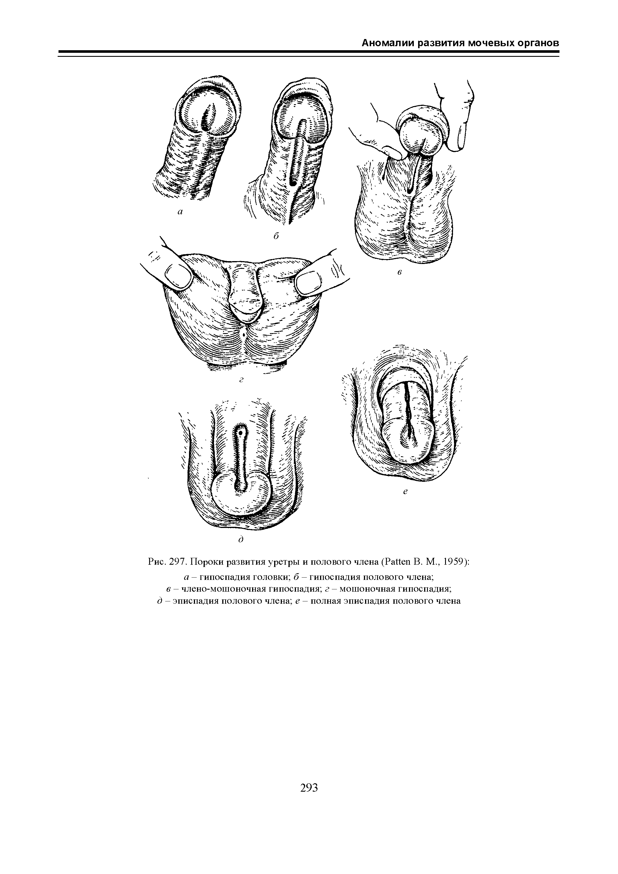 Рис. 297. Пороки развития уретры и полового члена (P В. М., 1959) а — гипоспадия головки б — гипоспадия полового члена ...