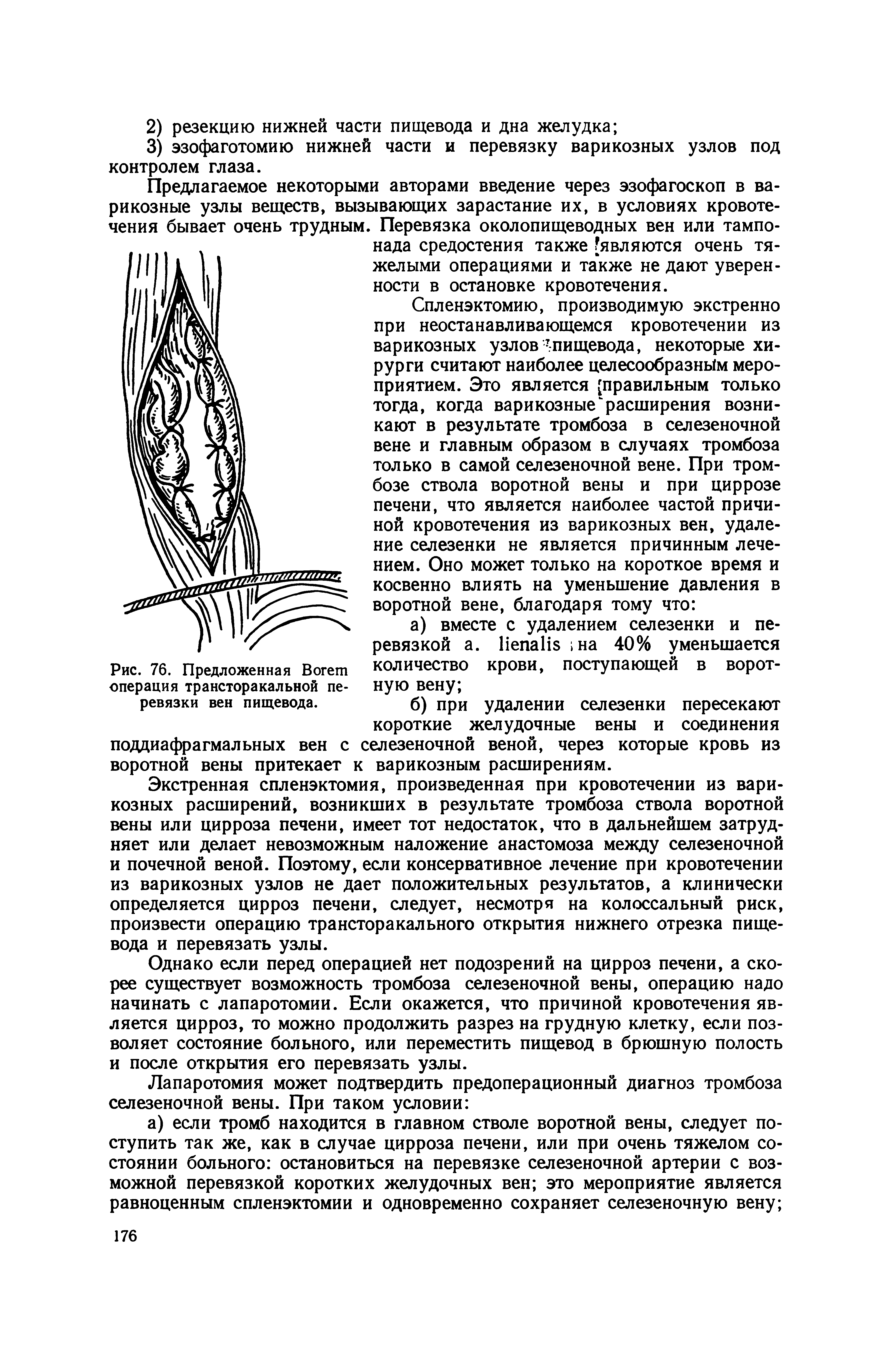 Рис. 76. Предложенная Вогет операция трансторакальной перевязки вен пищевода.