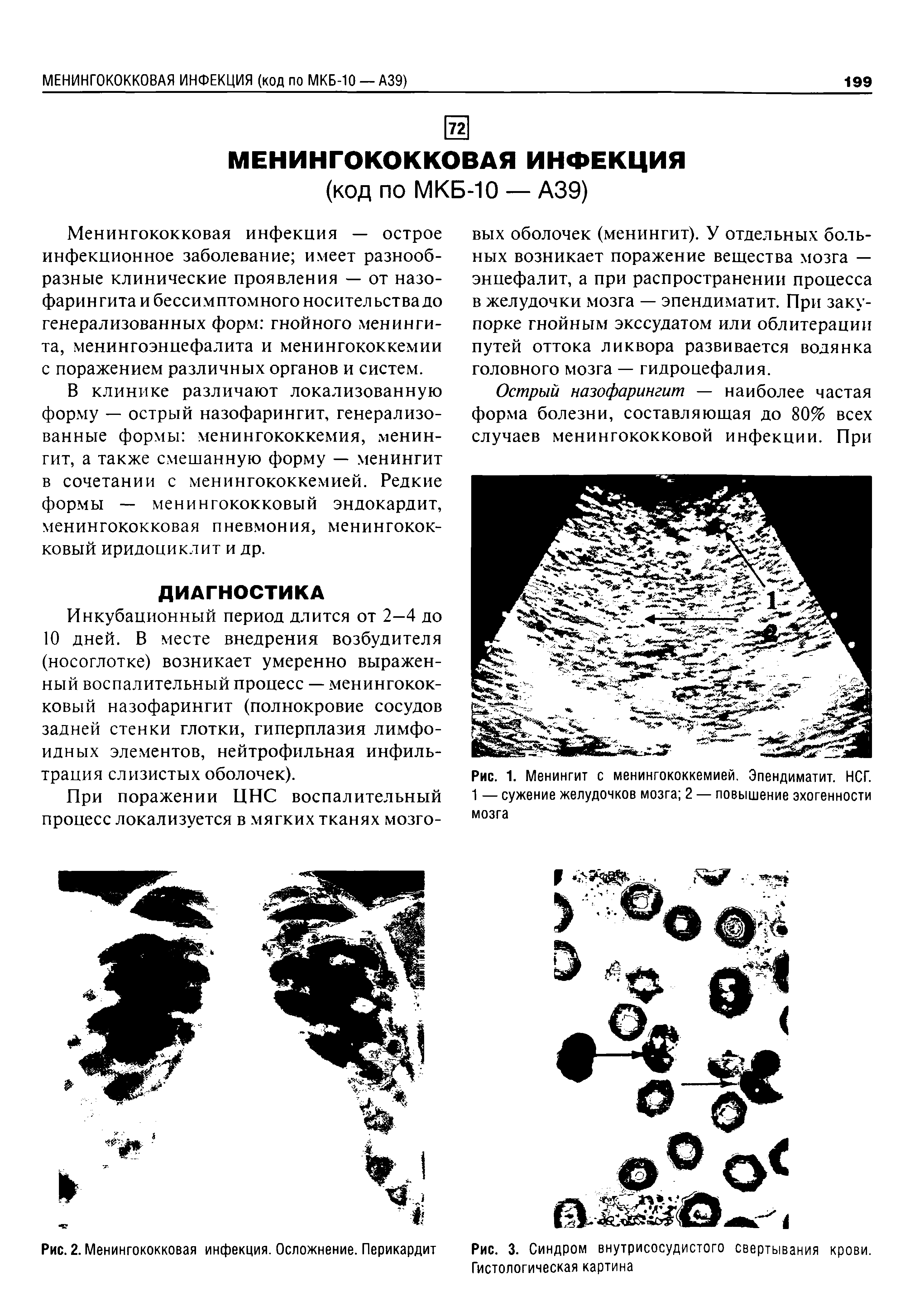 Рис. 3. Синдром внутрисосудистого свертывания крови. Гистологическая картина...