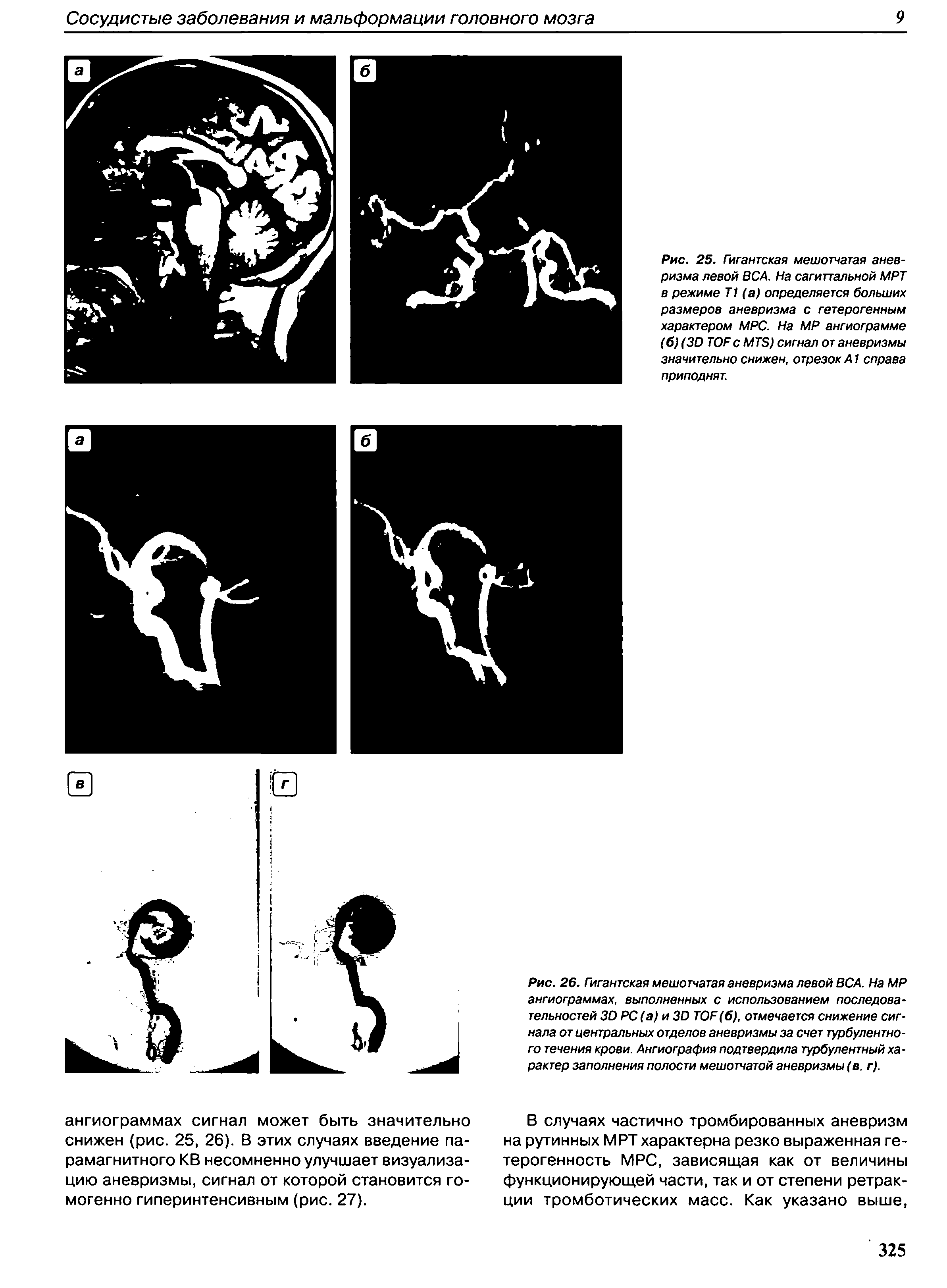 Рис. 26. Гигантская мешотчатая аневризма левой ВСА. На МР ангиограммах, выполненных с использованием последовательностей 30 РС (а) и 30 ТОГ (6), отмечается снижение сигнала от центральных отделов аневризмы за счет турбулентного течения крови. Ангиография подтвердила турбулентный характер заполнения полости мешотчатой аневризмы (в. г).