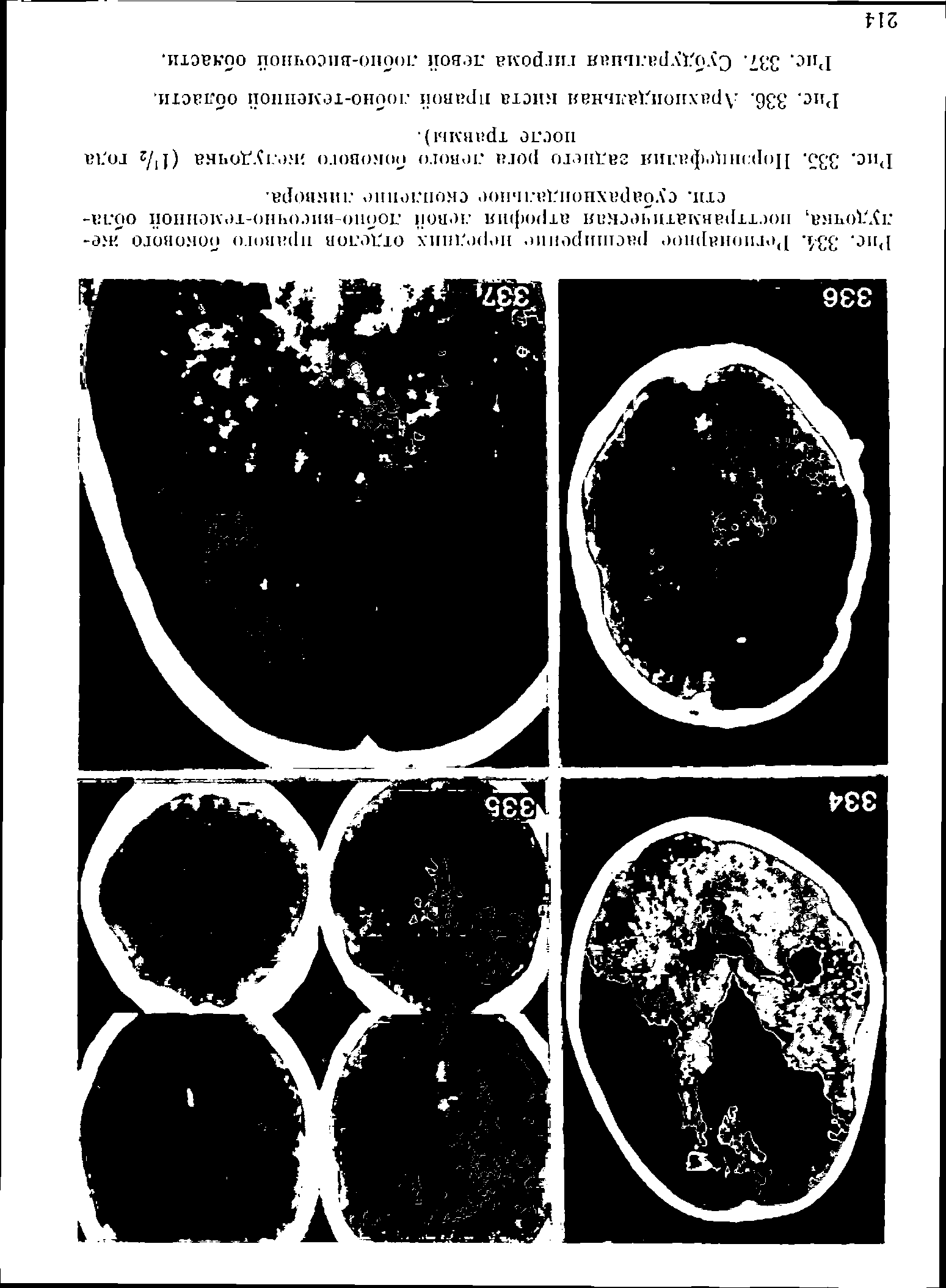 Рис. 334. Регионарное расширение передних отделов правого бокового желудочка, посттравматическая атрофия левой лобно-височно-теменной облает] . субарахноидальное скопление ликвора.