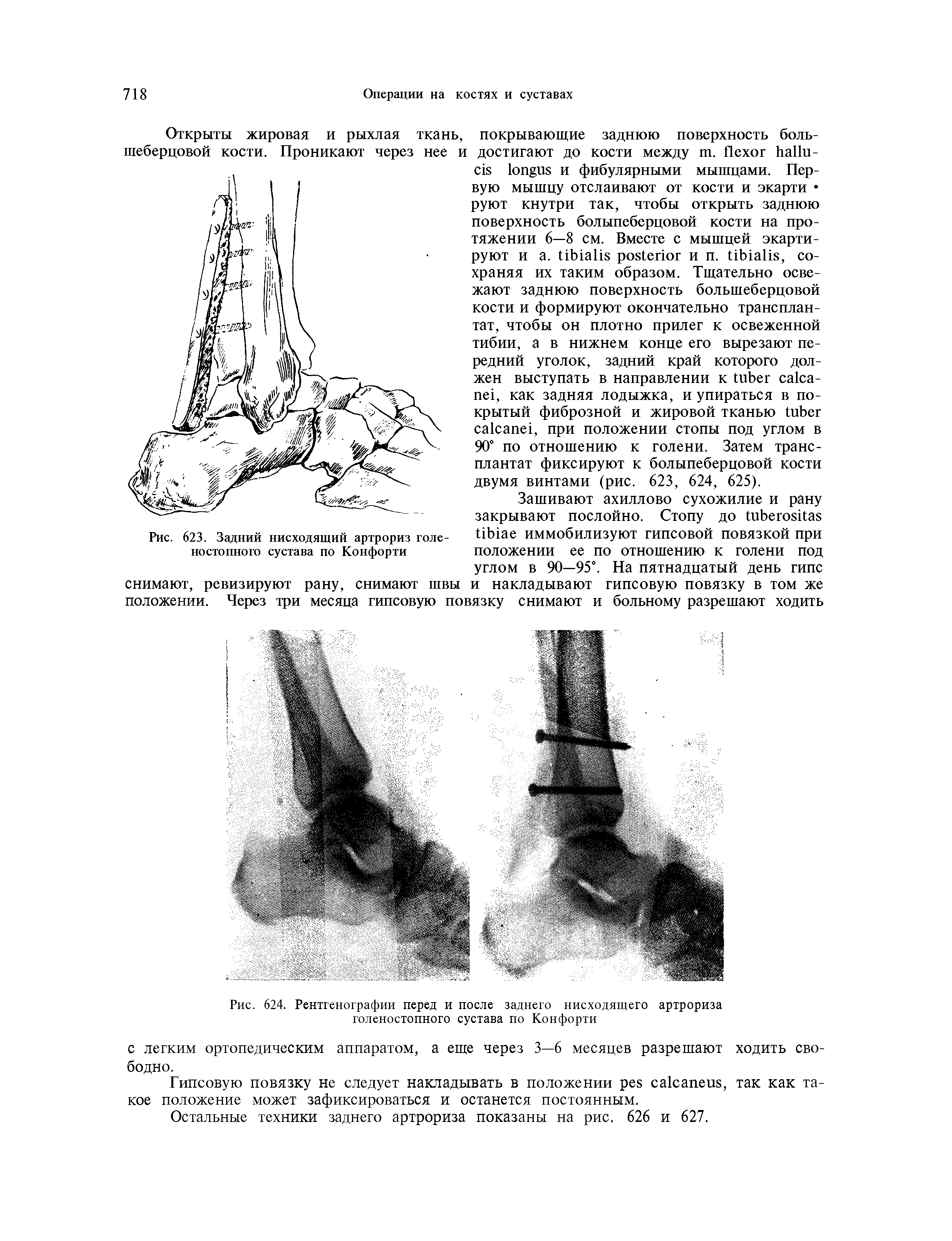 Рис. 624. Рентгенографии перед и после заднего нисходящего артрориза голеностопного сустава по Конфорти...