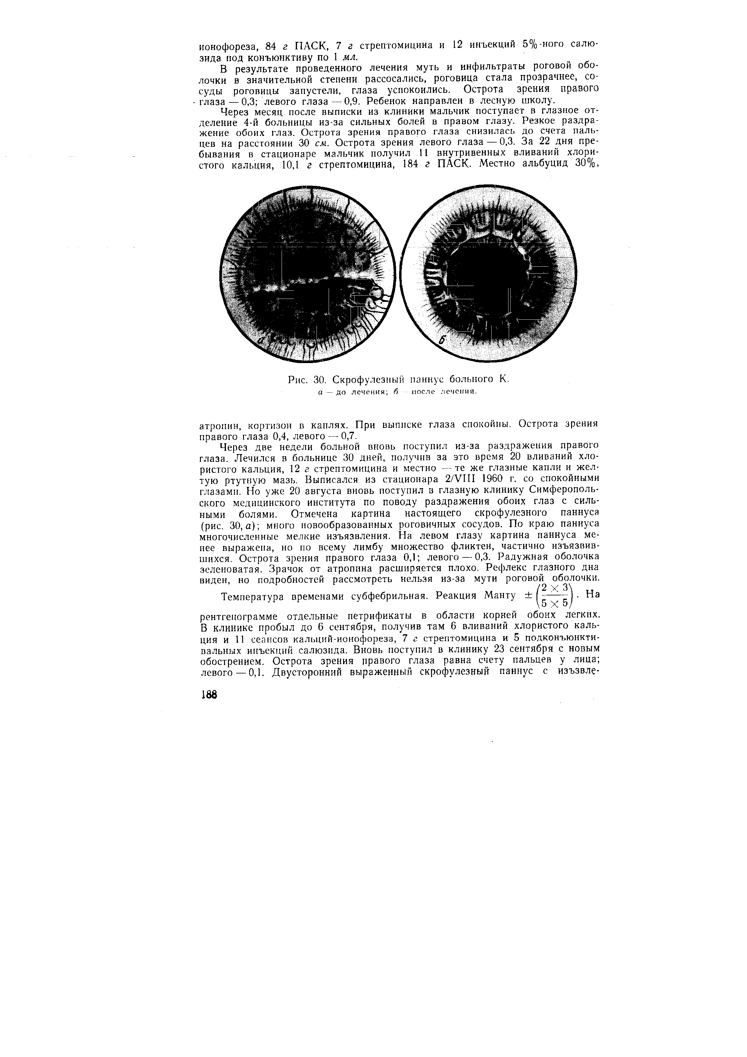 Рис. 30. Скрофулезным паннус больного К. а — до лечения б после лечения.