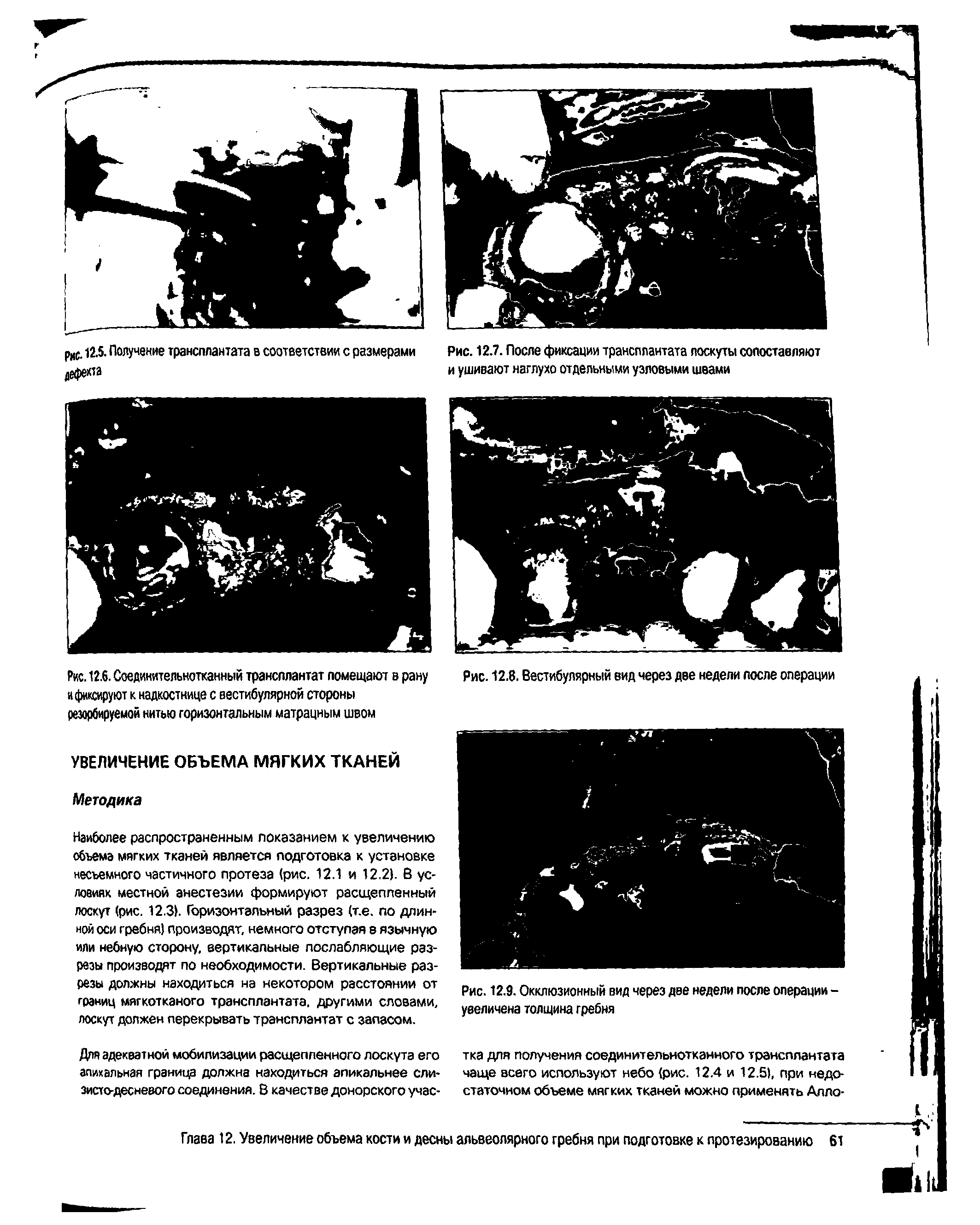 Рис. 12.6. Соединительнотканный трансплантат помещают в рану и фиксируют к надкостнице с вестибулярной стороны резорбируемой нитью горизонтальным матрацным швом...