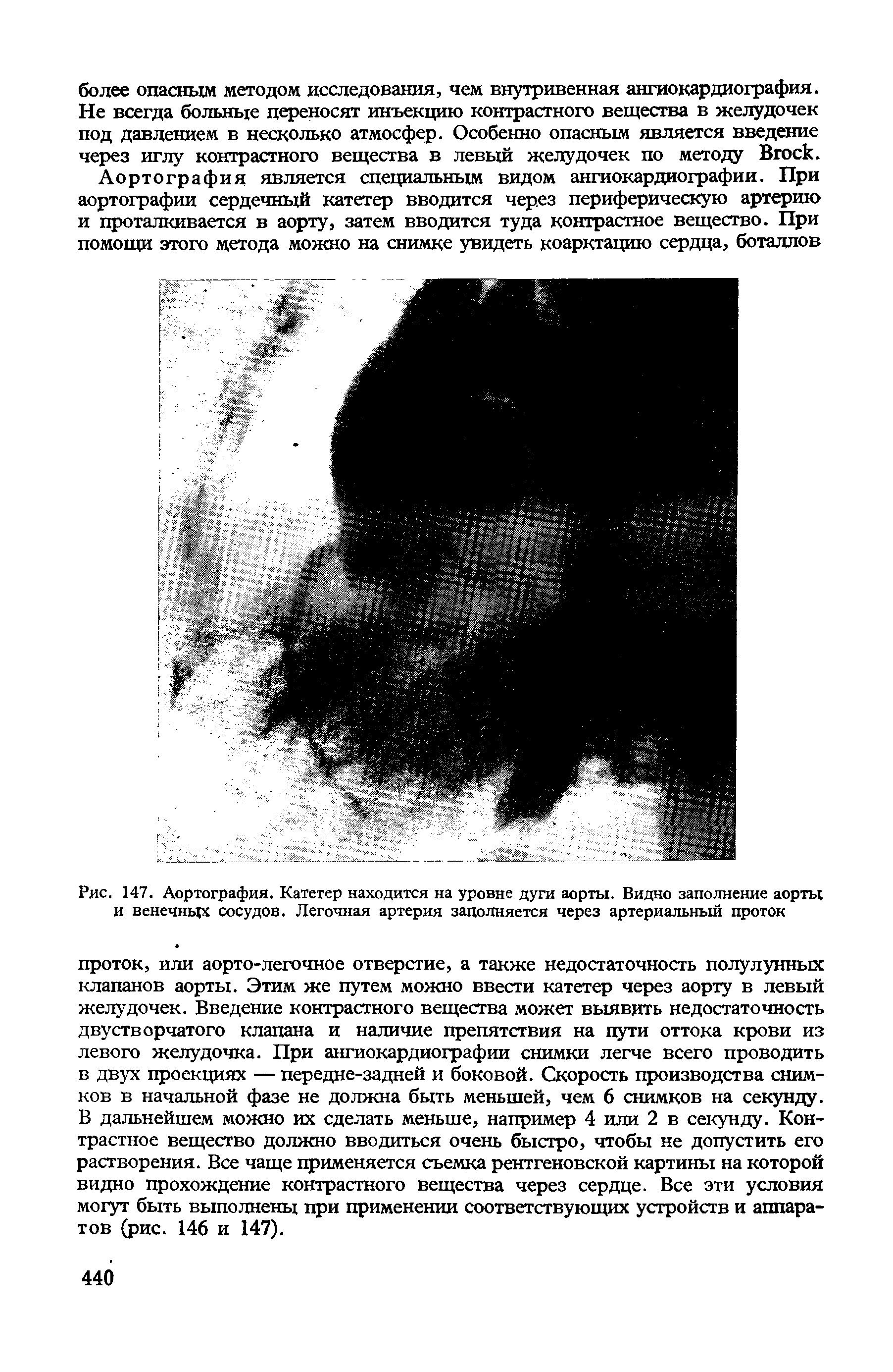 Рис. 147. Аортография. Катетер находится на уровне дуги аорты. Видно заполнение аорты и венечных сосудов. Легочная артерия заполняется через артериальный проток...