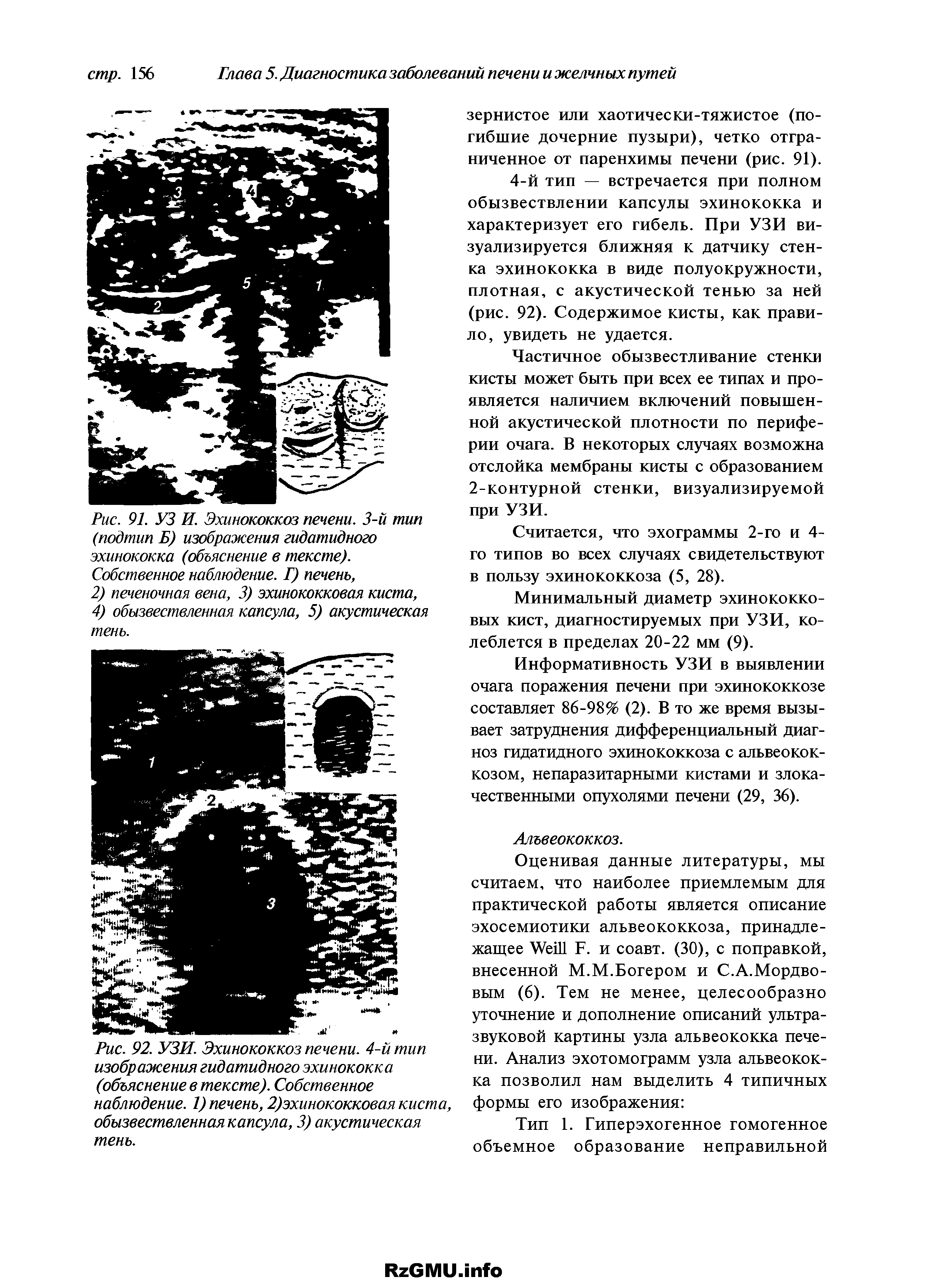 Рис. 91. УЗ И. Эхинококкоз печени. 3-й тип (подтип Б) изображения гидатидного эхинококка (объяснение в тексте). Собственное наблюдение. Г) печень, 2) печеночная вена, 3) эхинококковая киста, 4) обызвествленная капсула, 5) акустическая тень.