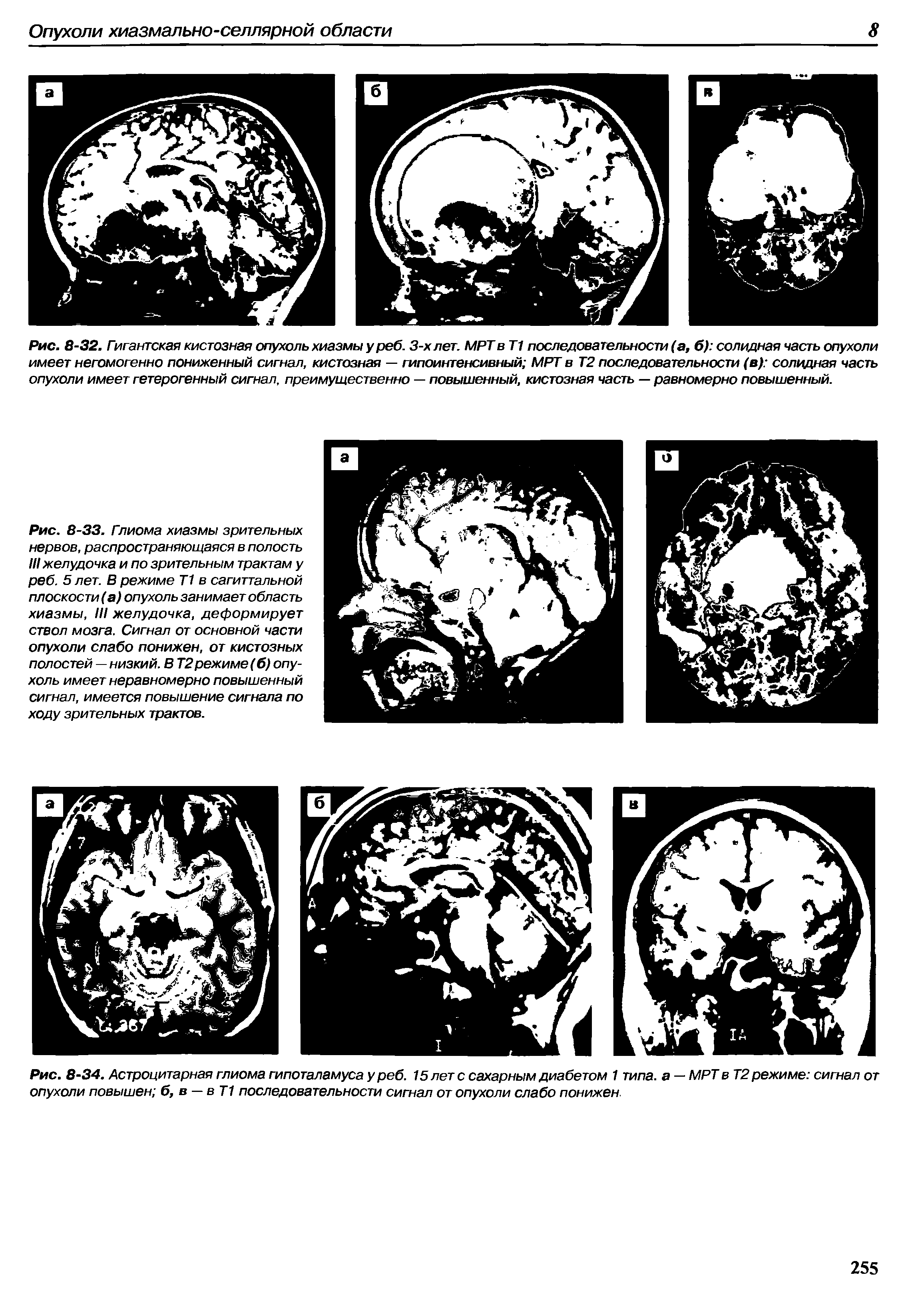 Рис. 8-34. Астроцитарная глиома гипоталамуса у реб. 15 лет с сахарным диабетом 1 типа, а — МРТ в Т2 режиме сигнал от опухоли повышен б, в — в Т1 последовательности сигнал от опухоли слабо понижен.