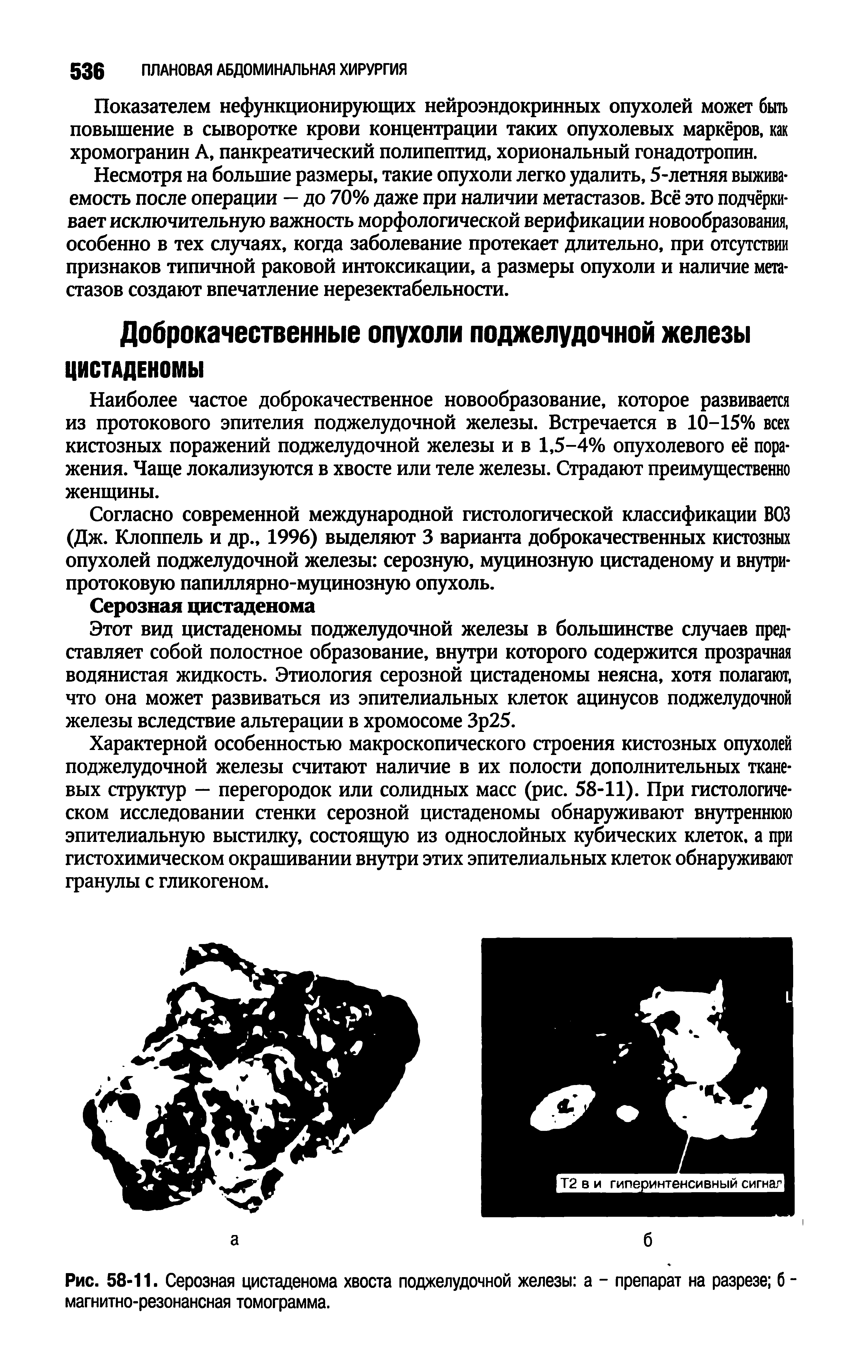 Рис. 58-11. Серозная цистаденома хвоста поджелудочной железы а - препарат на разрезе б -магнитно-резонансная томограмма.