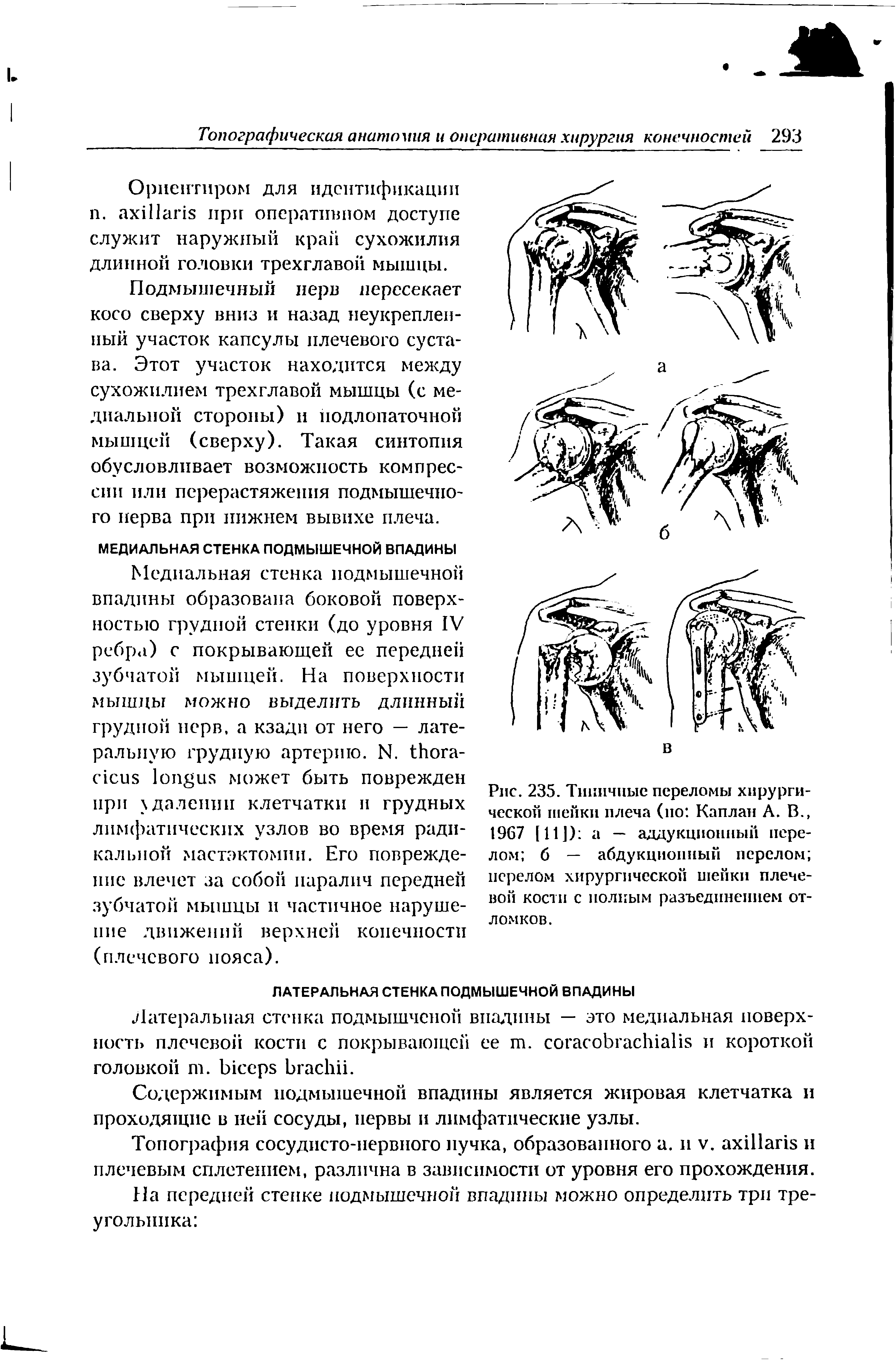 Рис. 235. Типичные переломы хирургической шейки плеча (ио Каплан А. В., 1967 [И]) 1 — аддукциониый перелом б — абдукциониый перелом перелом хирургической шейки плечевой кости с полным разъединением отломков.