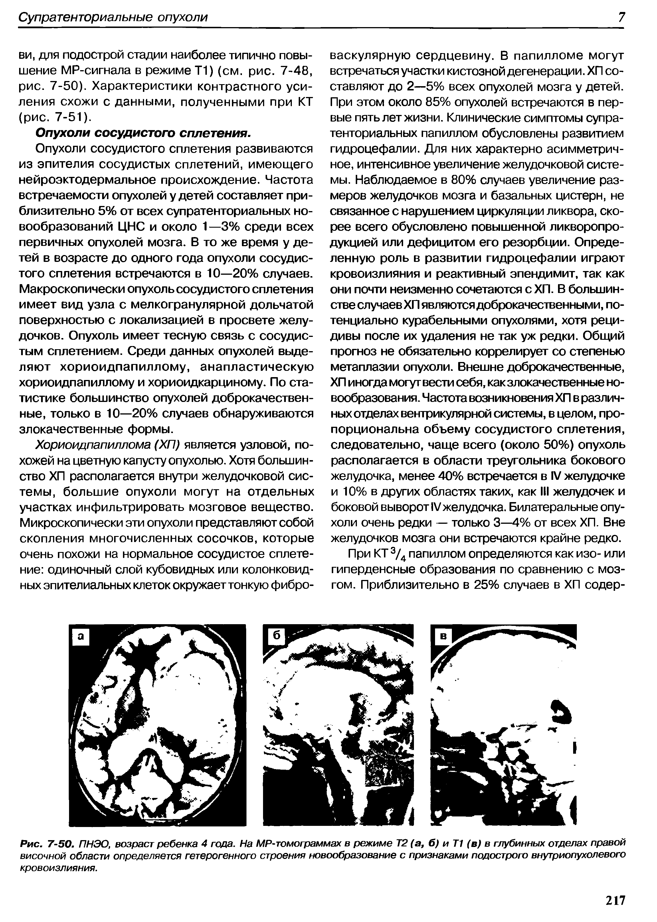 Рис. 7-50. ПНЭО, возраст ребенка 4 года. На MP-томограммах в режиме Т2 (а, б) и Т1 (в) в глубинных отделах правой височной области определяется гетерогенного строения новообразование с признаками подострого внутриопухолевого кровоизлияния.