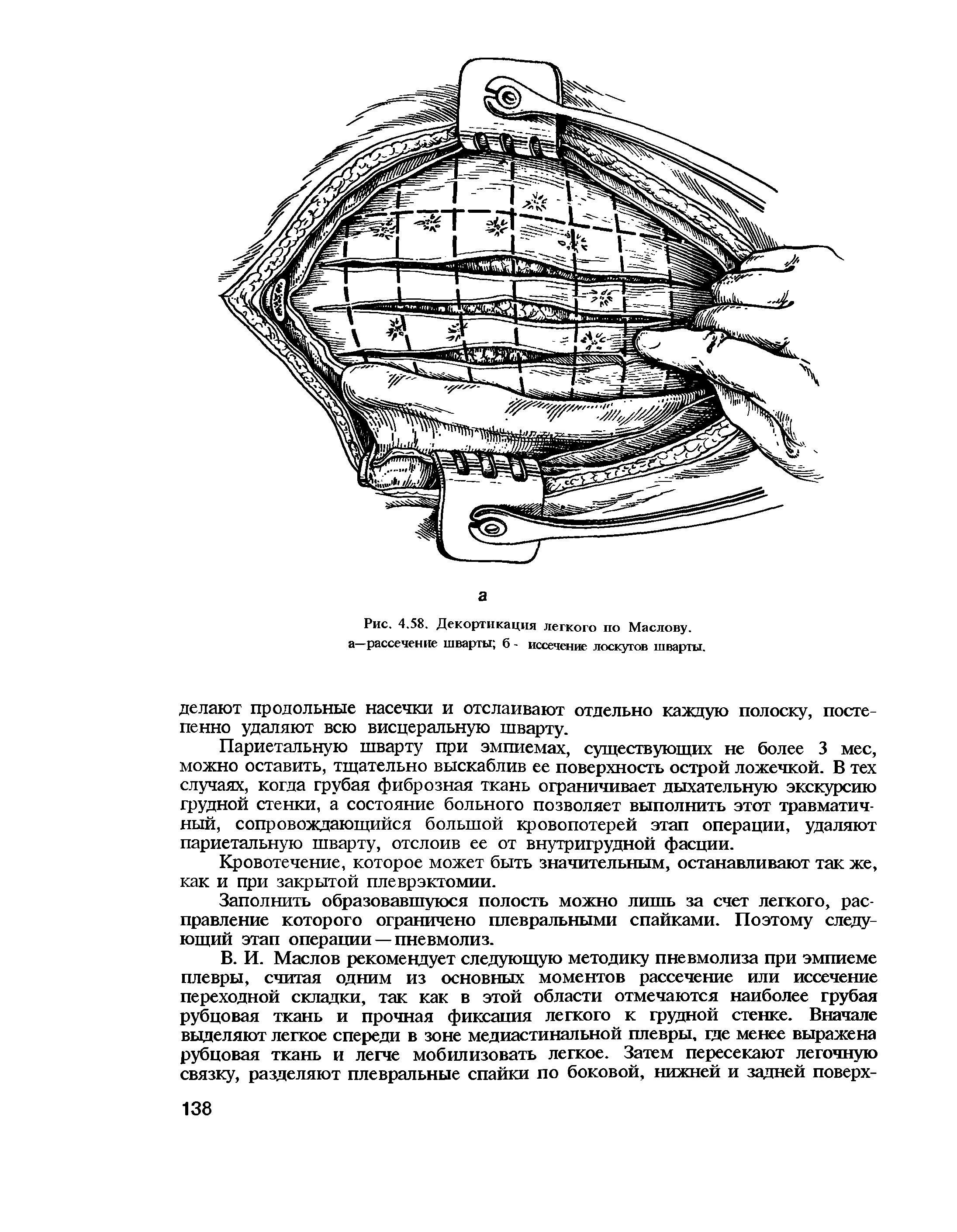 Рис. 4.58. Декортикация легкого по Маслову, а—рассечение шварты 6 - иссечение лоскутов шварты.