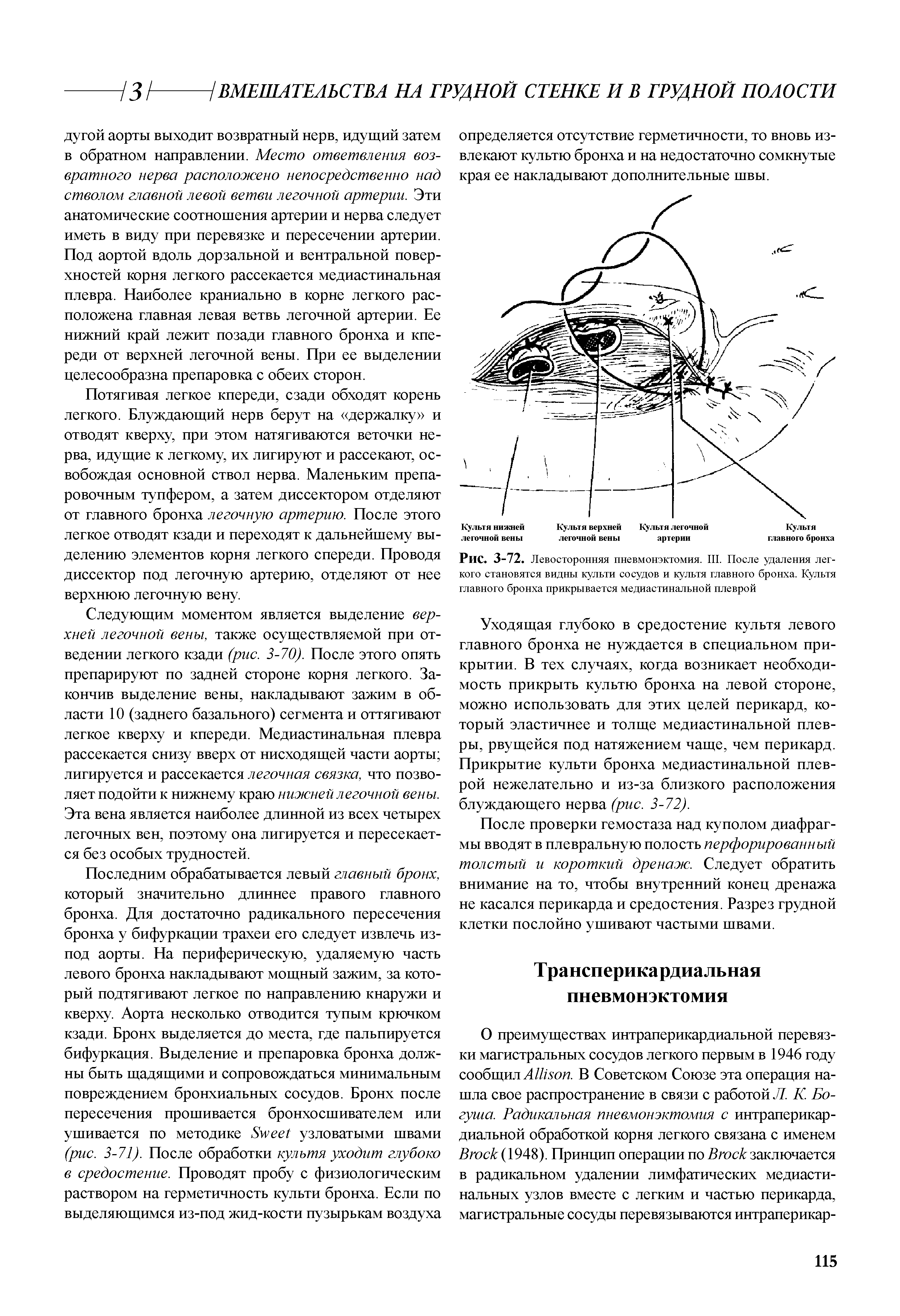 Рис. 3-72. Левосторонняя пневмонэктомия. III. После удаления лег-кого становятся видны культи сосудов и культя главного бронха. Культя главного бронха прикрывается медиастинальной плеврой...