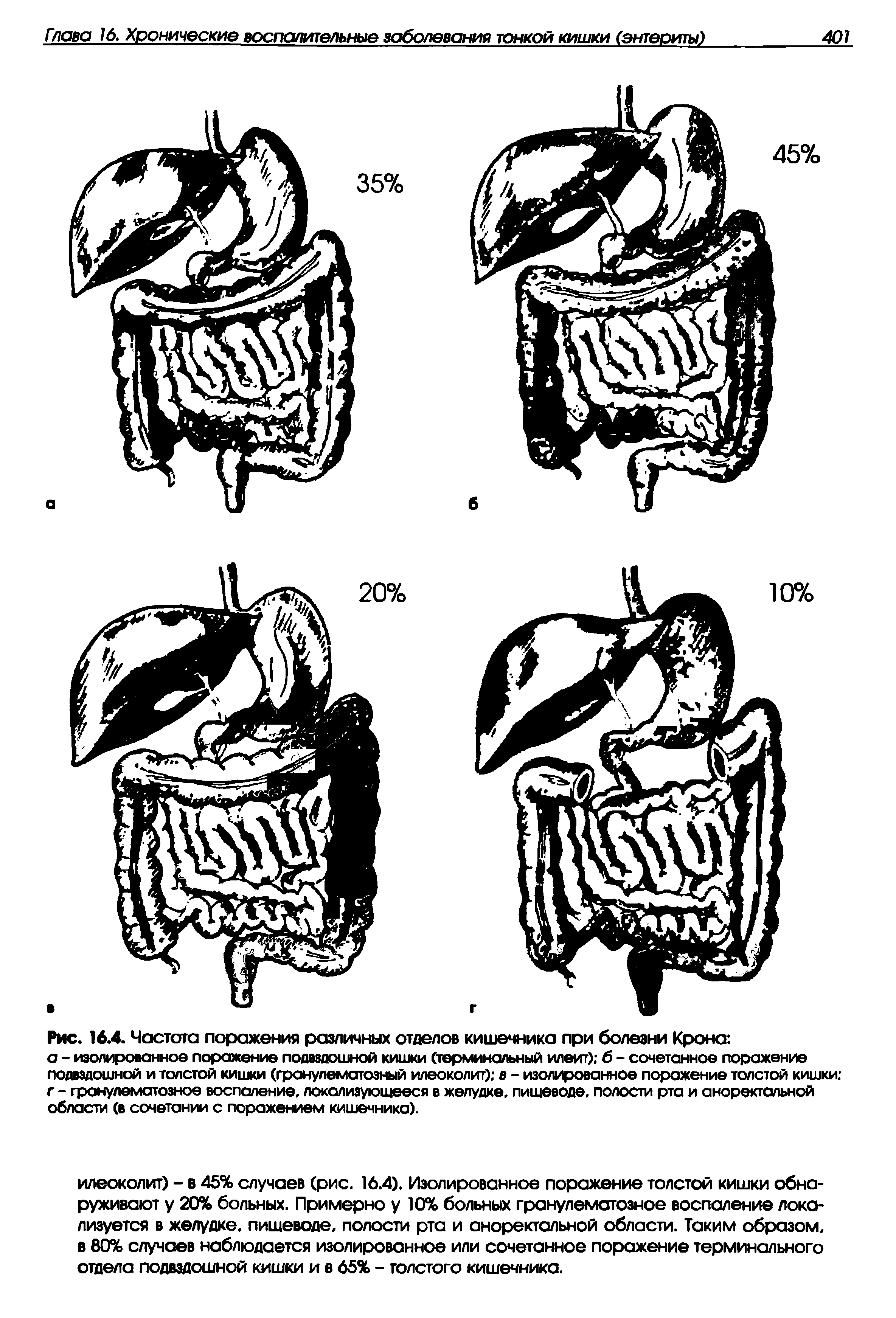 Рис. 16.4. Частота поражения различных отделов кишечника при болезни Крона ...