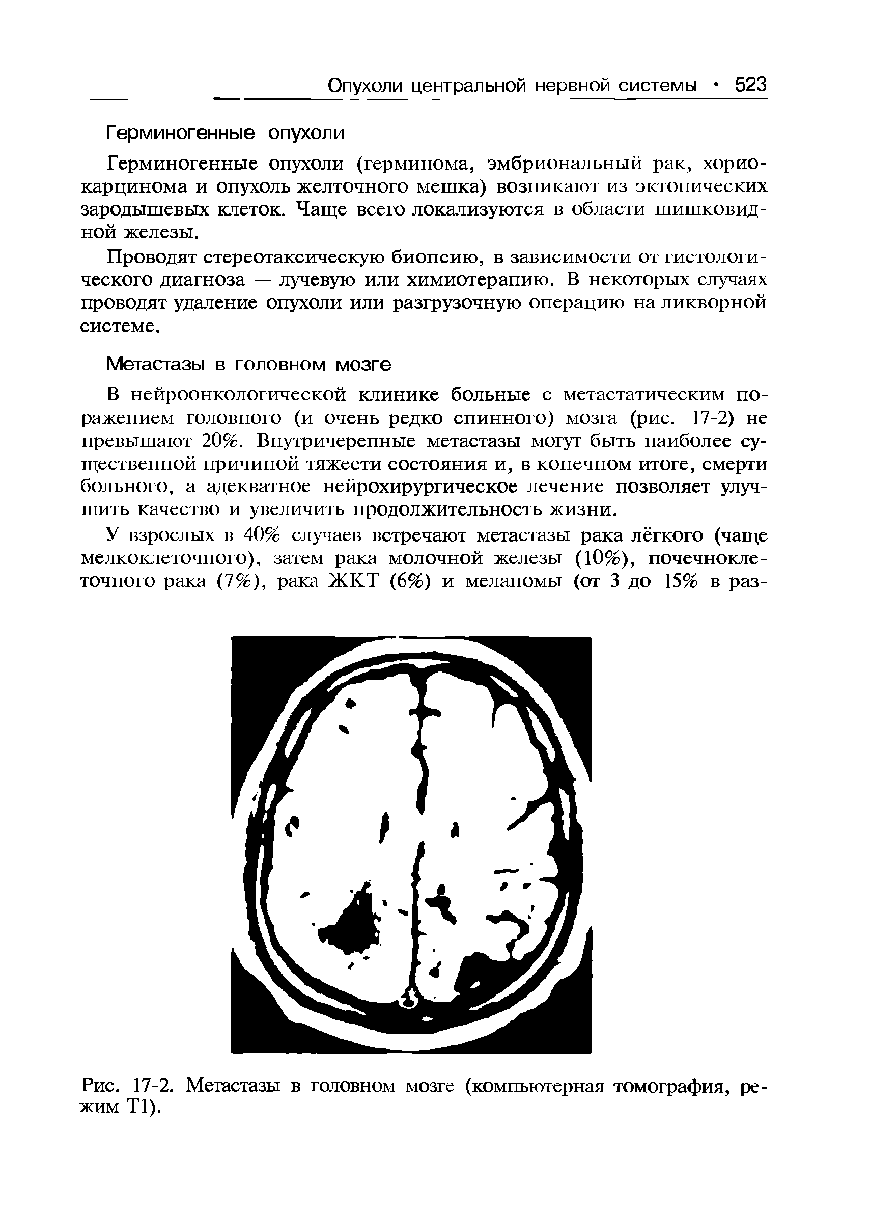 Рис. 17-2. Метастазы в головном мозге (компьютерная томография, режим Т1).