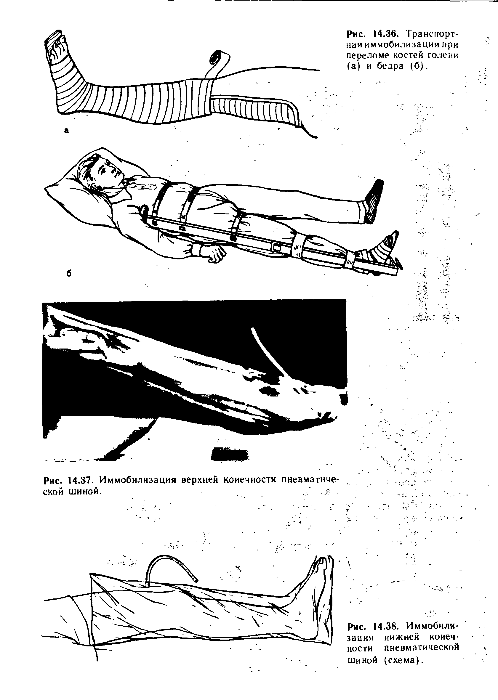 Рис. 14.38. Иммобилизация нижней конечности пневматической шиной (схема).