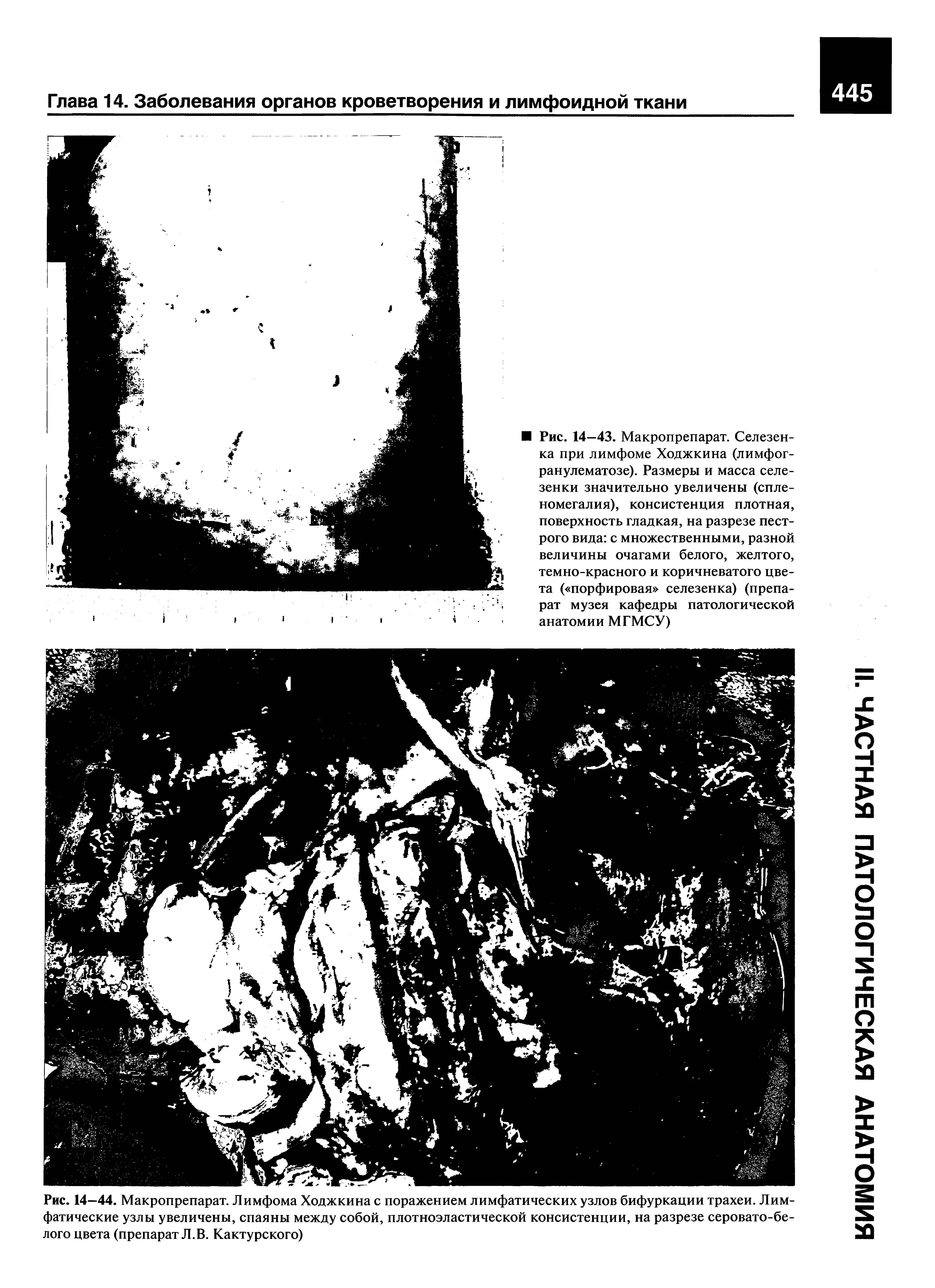 Рис. 14—44. Макропрепарат. Лимфома Ходжкина с поражением лимфатических узлов бифуркации трахеи. Лимфатические узлы увеличены, спаяны между собой, плотноэластической консистенции, на разрезе серовато-белого цвета (препарат Л.В. Кактурского)...