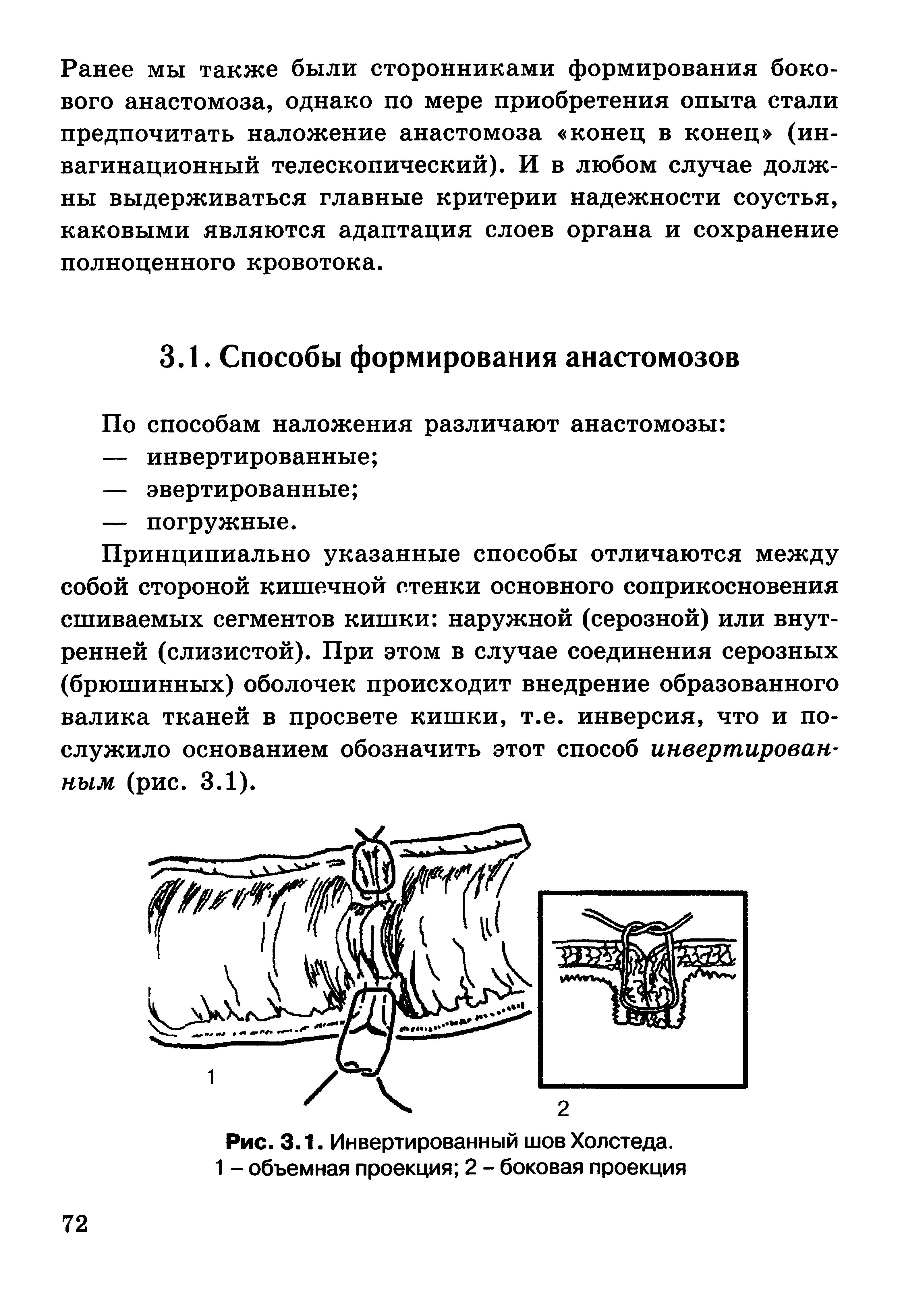 Рис. 3.1. Инвертированный шов Холстеда. 1 - объемная проекция 2 - боковая проекция...