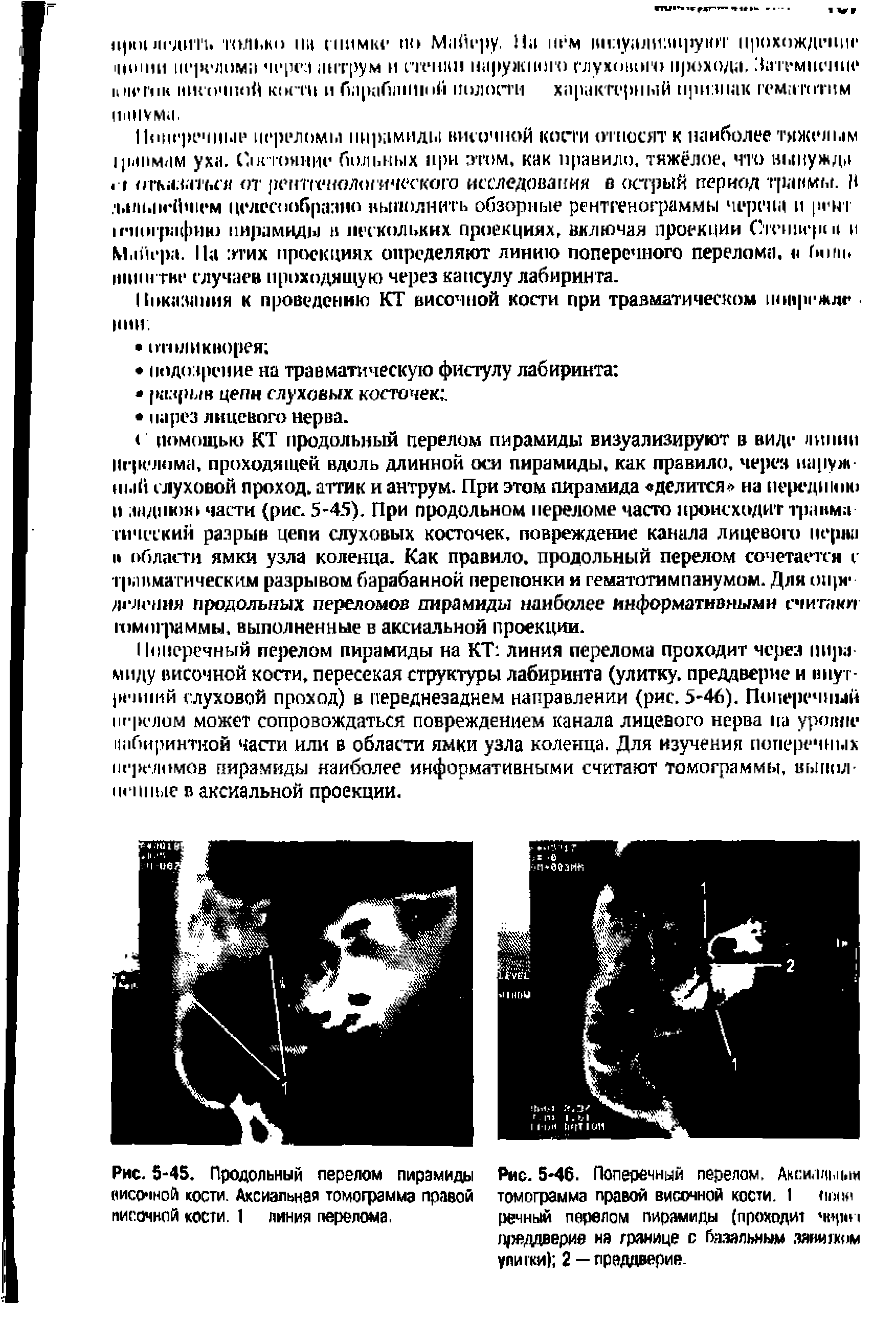 Рис. 5-45. Продольный перелом пирамиды височной кости. Аксиальная томограмма правой писачкой кости. 1 линия перелома.