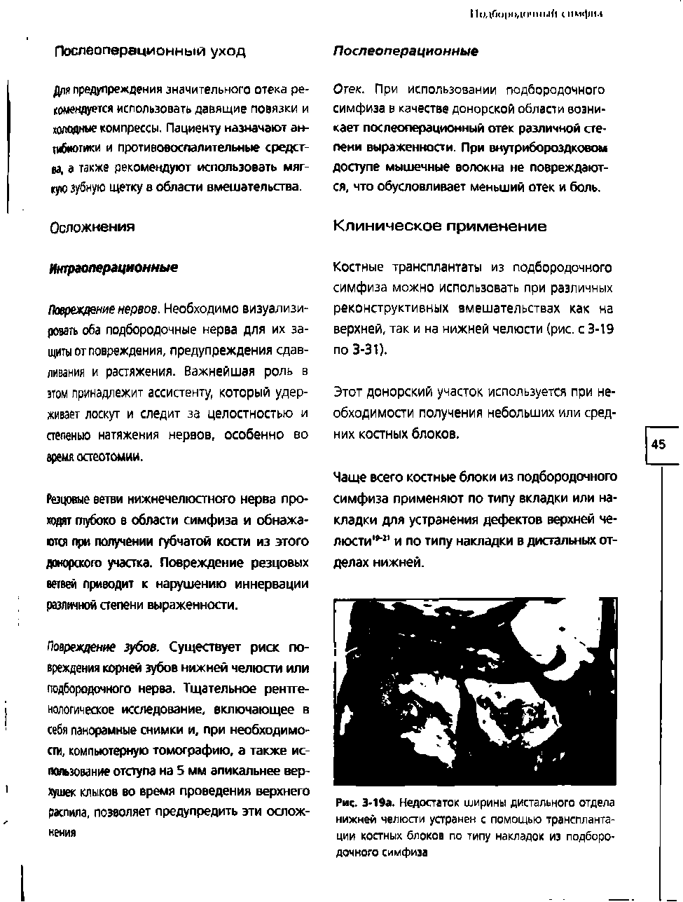 Рис. Э-19а. Недостаток ширины дистального отдела нижней челюсти устранен с помощью трансплантации костных блоков по типу накладок из подбородочного симфиза...