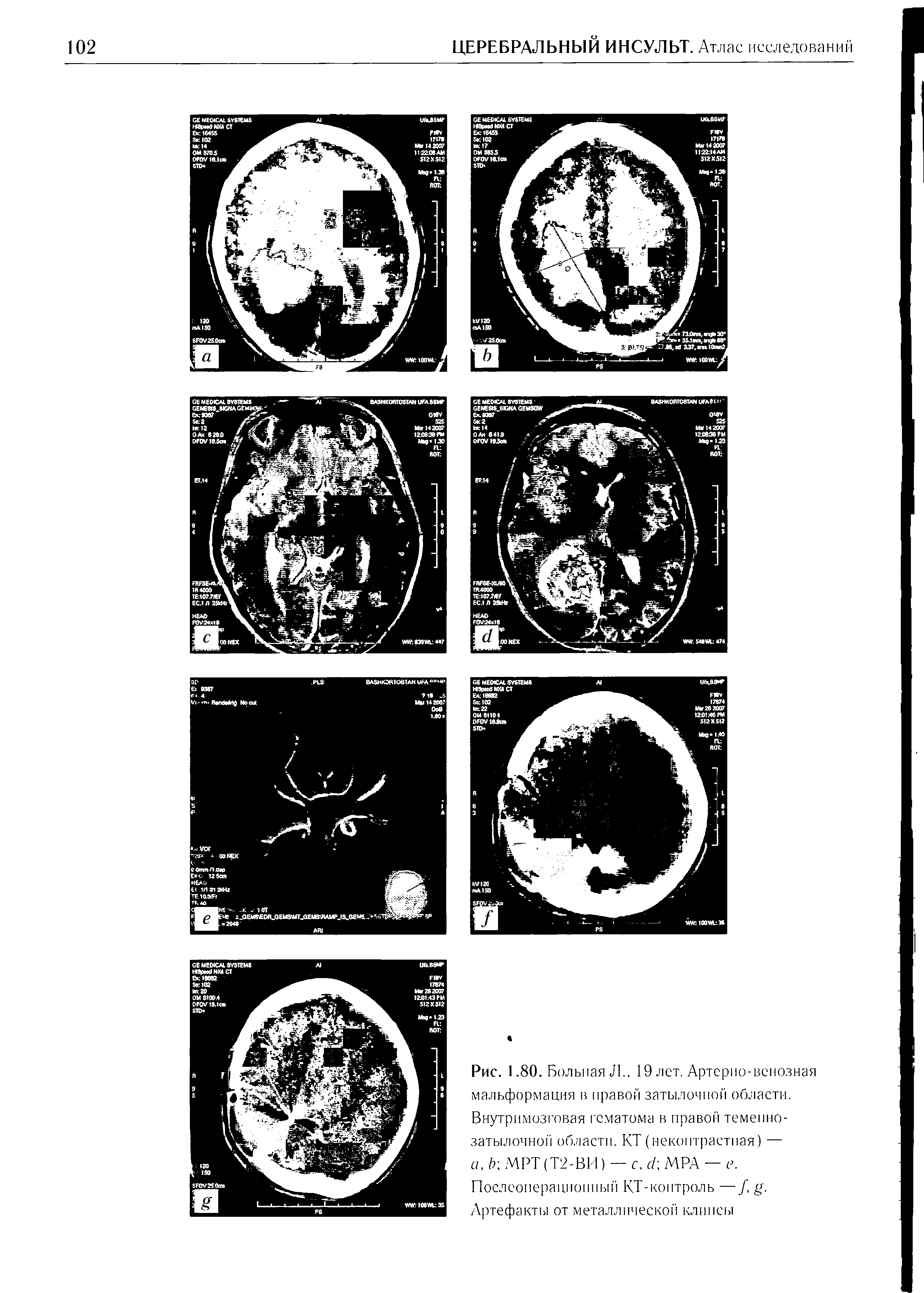 Рис. 1.80. Больная Л.. 19 лет. Артерио-венозная мальформация в правой затылочной области. Внутримозговая гематома в правой теменнозатылочной области. КТ (неконтрастная) — а, Ь МРТ (Т2-В11) — с, (1 МРА — е. Послеоперационный КТ-коитроль —/, с Артефакты от металлической клипсы...