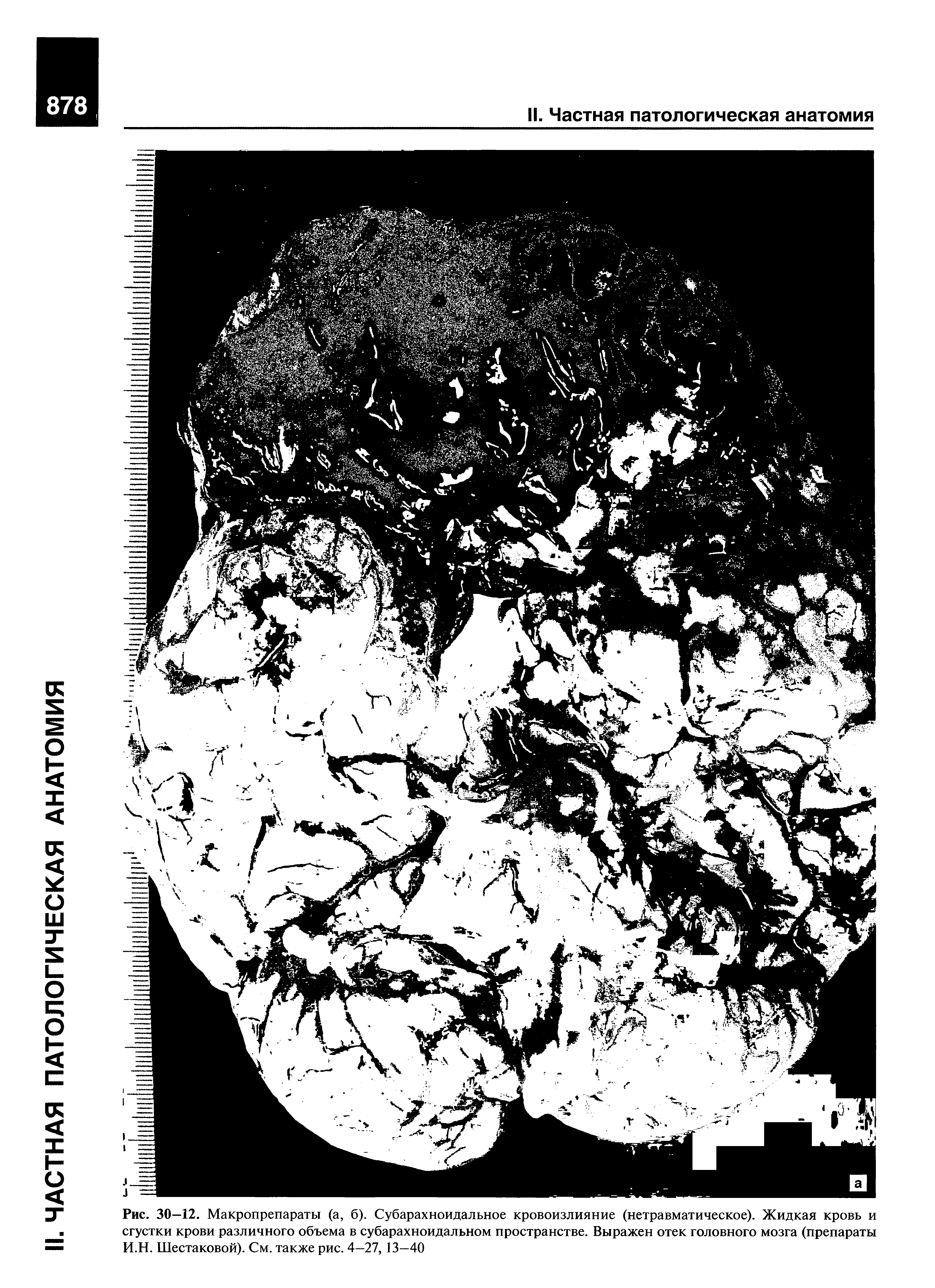 Рис. 30—12. Макропрепараты (а, б). Субарахноидальное кровоизлияние (нетравматическое). Жидкая кровь и сгустки крови различного объема в субарахноидальном пространстве. Выражен отек головного мозга (препараты И.Н. Шестаковой). См. также рис. 4—27, 13—40...