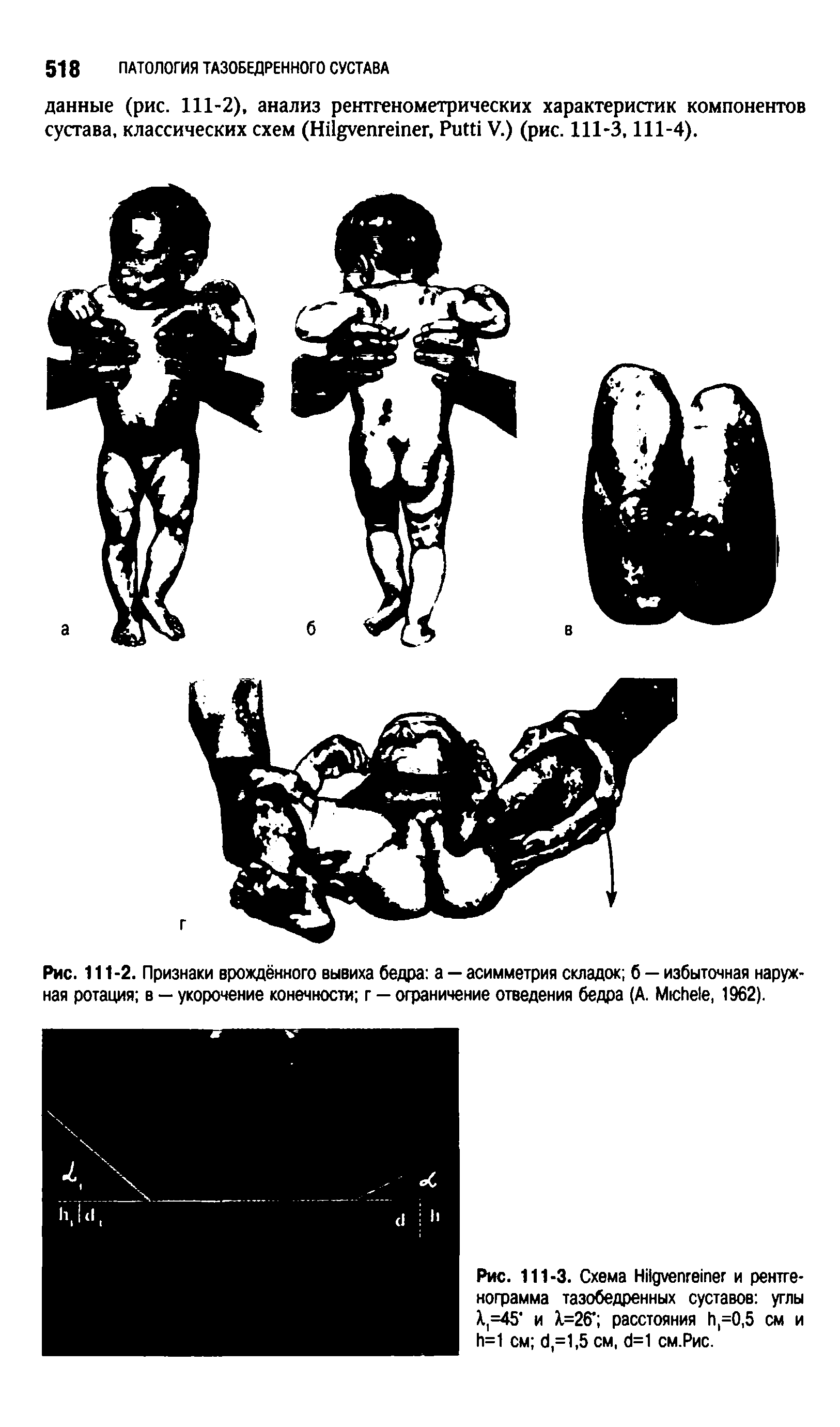 Рис. 111-2. Признаки врождённого вывиха бедра а — асимметрия складок б — избыточная наружная ротация в — укорочение конечности г — ограничение отведения бедра (А. МюИе1е, 1962).