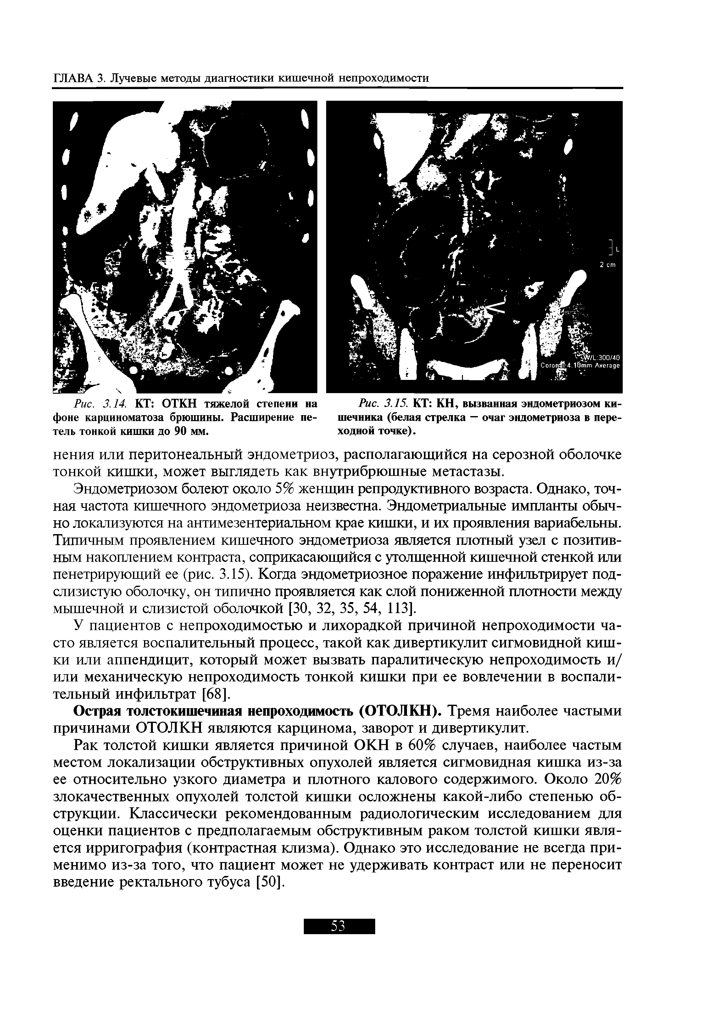 Рис. 3.15. КТ КН, вызванная эндометриозом кишечника (белая стрелка — очаг эндометриоза в переходной точке).