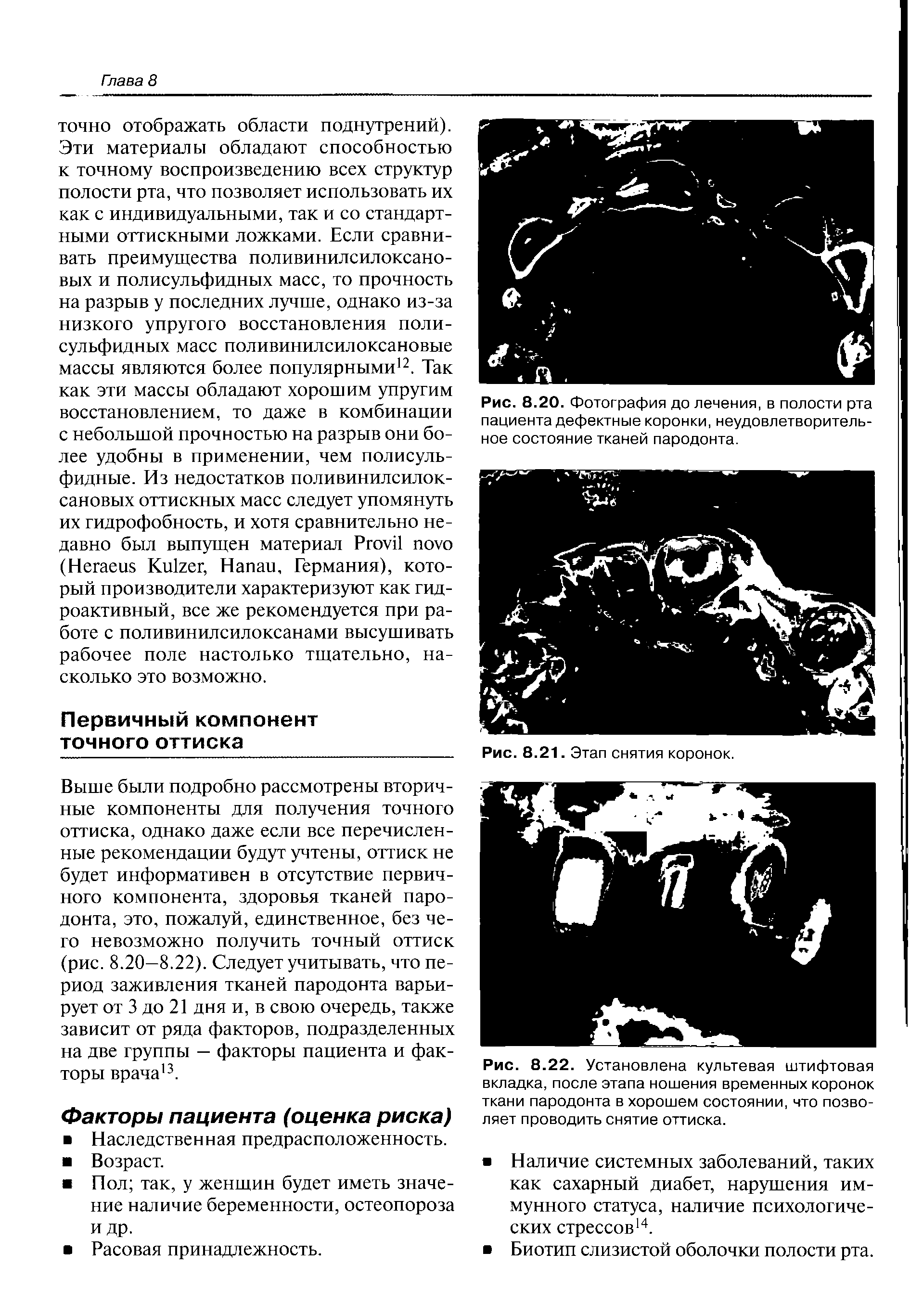 Рис. 8.22. Установлена культевая штифтовая вкладка, после этапа ношения временных коронок ткани пародонта в хорошем состоянии, что позволяет проводить снятие оттиска.